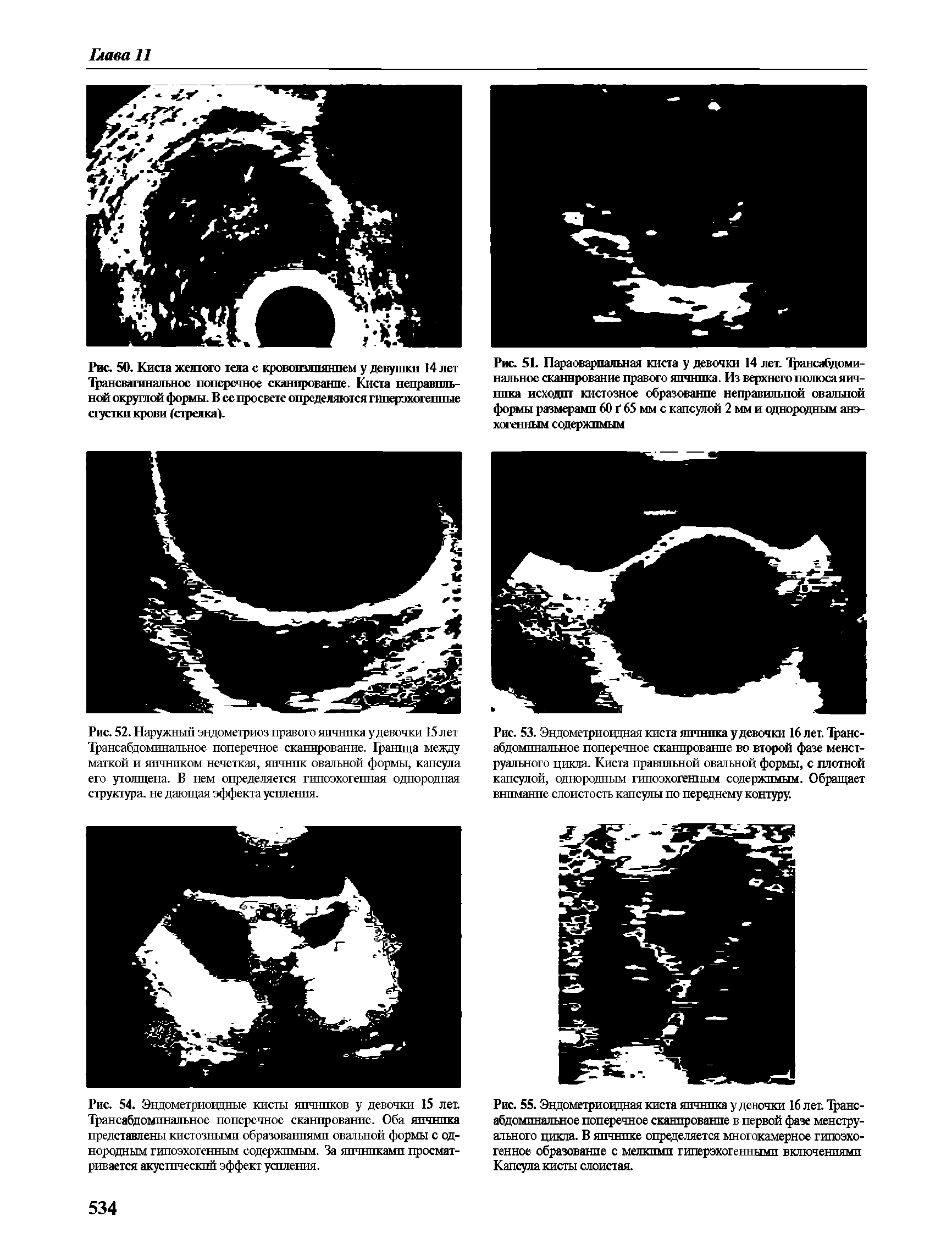Рис. 55. Эндометриоидная киста яичника у девочки 16 лет. Трансабдомпнальное поперечное сканпрованпе в первой фазе менструального цикла. В яичнике определяется многокамерное гипоэхо-генное образование с мелкими гиперэхогеннымп включениями Капсула кисты слоистая.