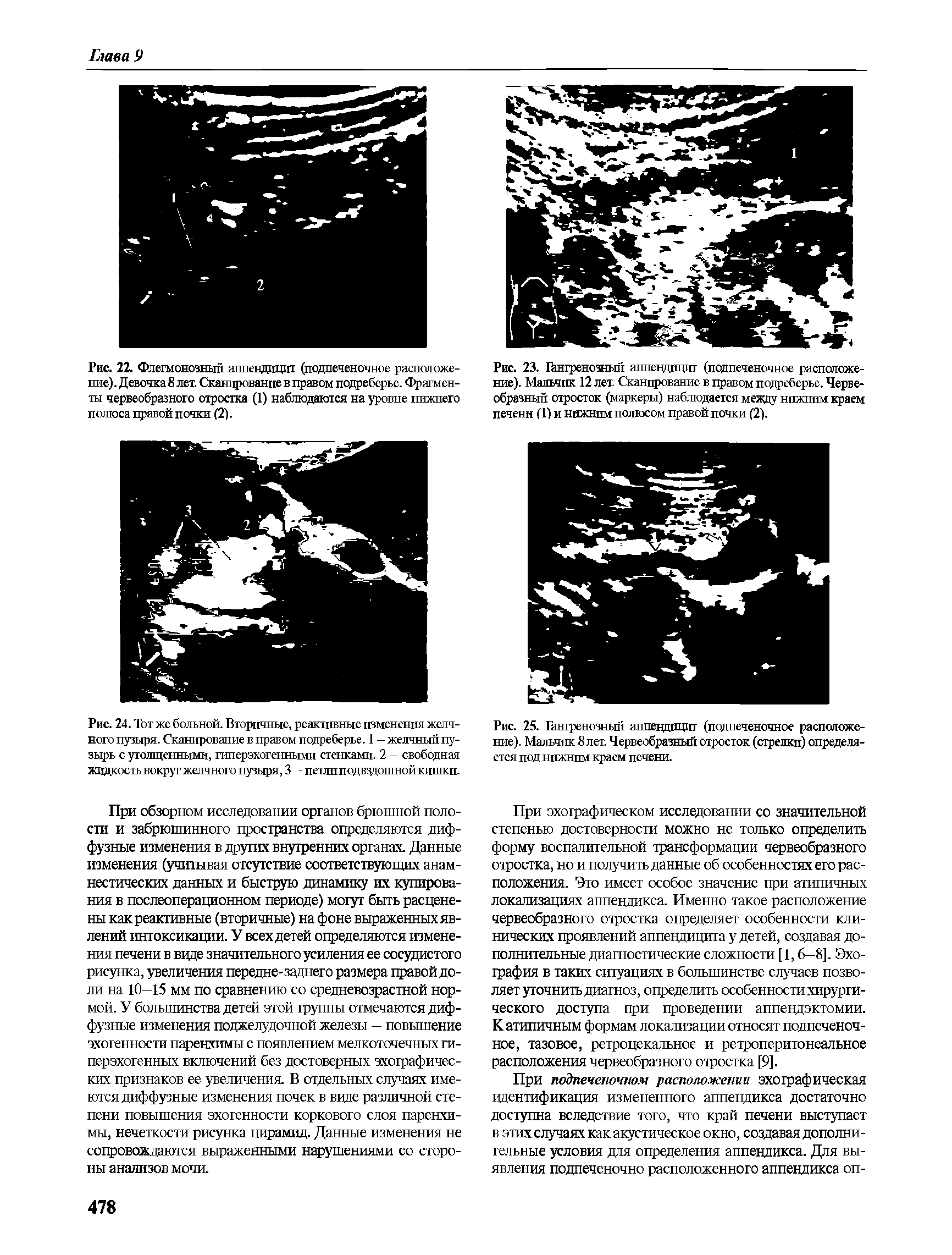 Рис. 24. Тот же больной. Вторичные, реактивные изменения желчного пузыря. Сканирование в правом подреберье. 1 - желчный пузырь с утолщенными, гиперэхогенными стенками. 2 - свободная жидкость вокруг желчного пузыря, 3 - петли подвздошной юпики.