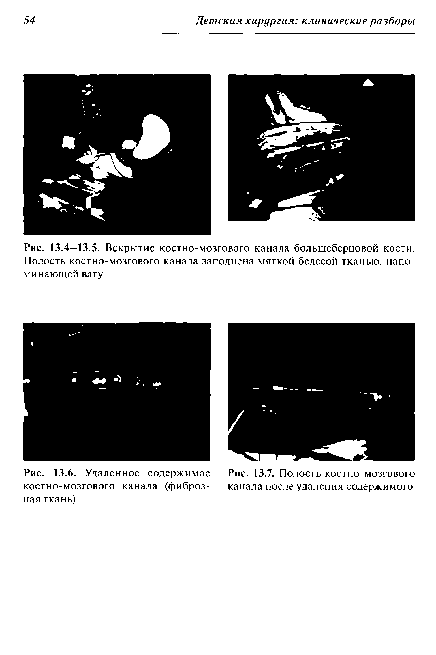 Рис. 13.6. Удаленное содержимое Рис. 13.7. Полость костно-мозгового костно-мозгового канала (фиброз- канала после удаления содержимого ная ткань)...
