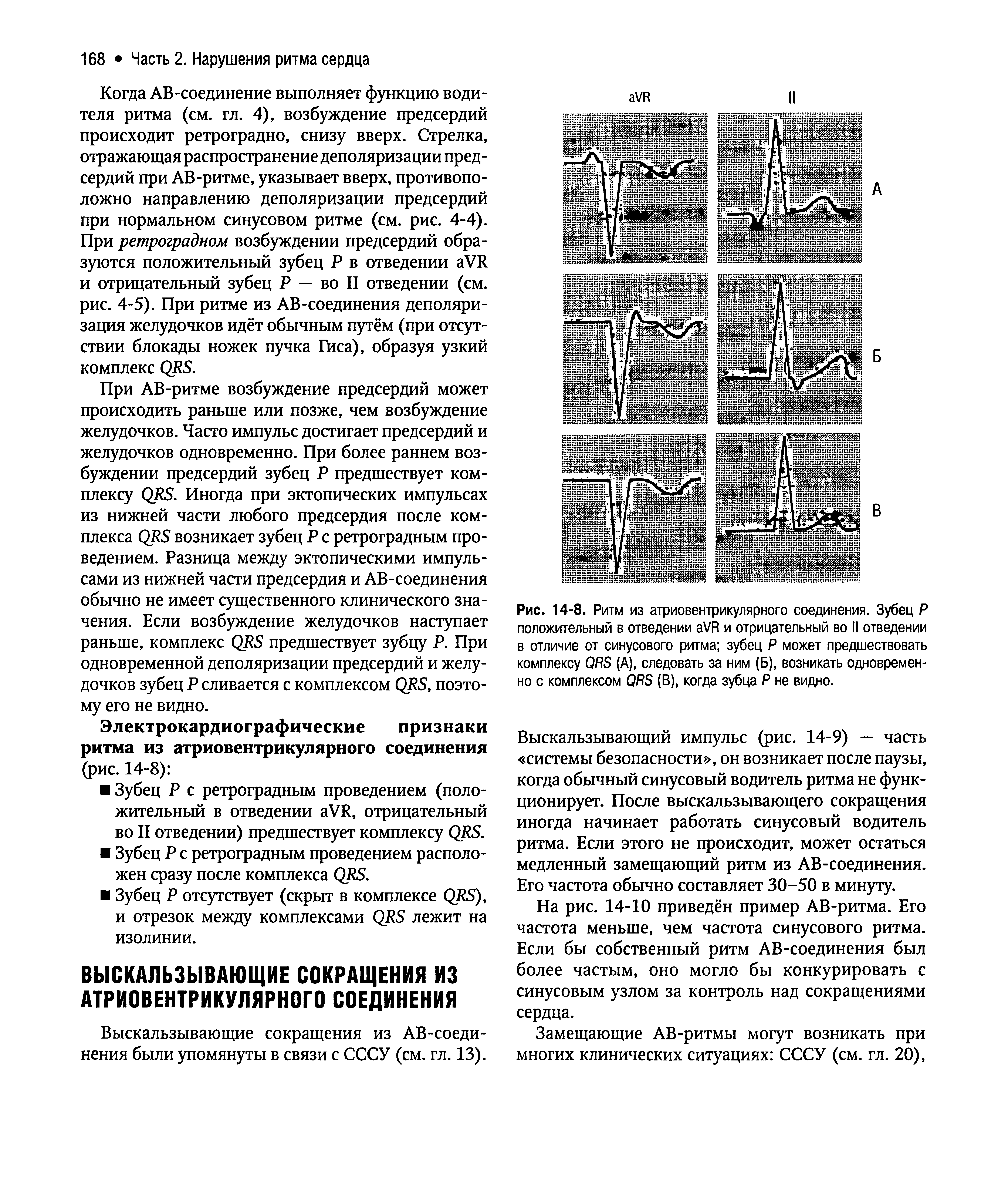 Рис. 14-8. Ритм из атриовентрикулярного соединения. Зубец Р положительный в отведении а /Р и отрицательный во II отведении в отличие от синусового ритма зубец Р может предшествовать комплексу ОЯБ (А), следовать за ним (Б), возникать одновременно с комплексом ОЯБ (В), когда зубца Р не видно.