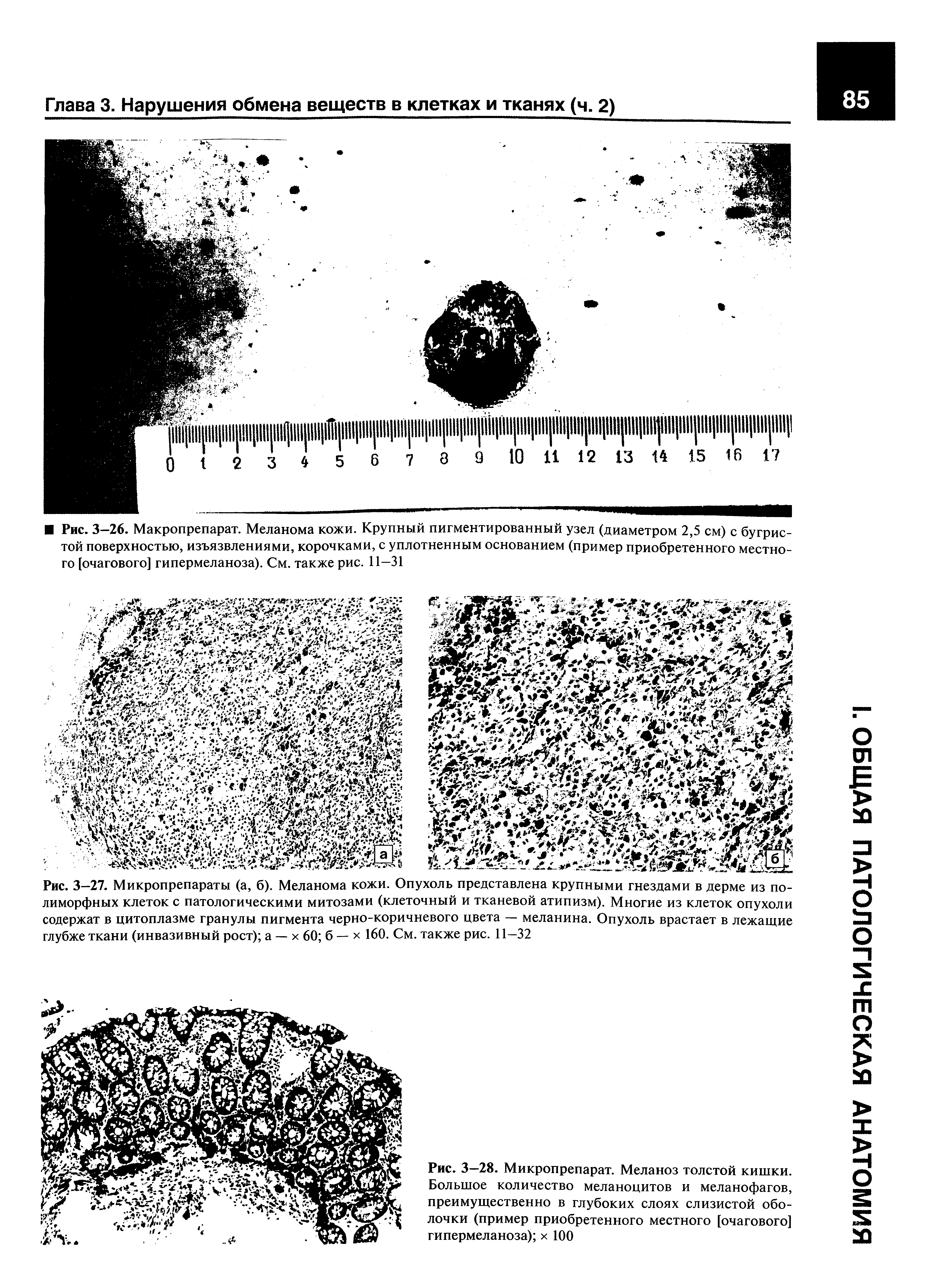 Рис. 3-27. Микропрепараты (а, б). Меланома кожи. Опухоль представлена крупными гнездами в дерме из полиморфных клеток с патологическими митозами (клеточный и тканевой атипизм). Многие из клеток опухоли содержат в цитоплазме гранулы пигмента черно-коричневого цвета — меланина. Опухоль врастает в лежащие глубже ткани (инвазивный рост) а — х 60 б — х 160. См. также рис. 11—32...