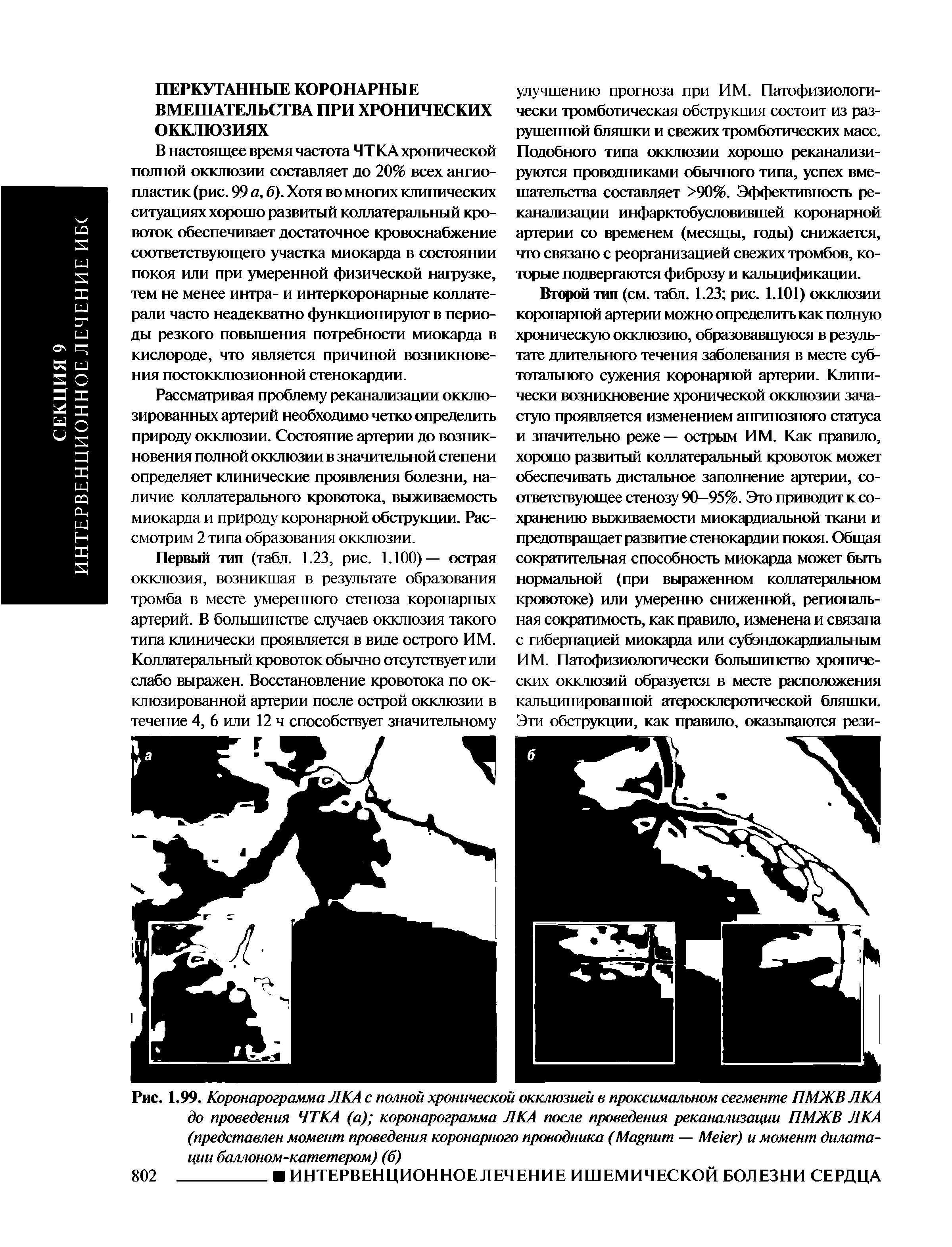 Рис. 1.99. Коронарограмма Л КА с полной хронической окклюзией в проксимальном сегменте ПМЖВ Л КА до проведения ЧТКА (а) коронарограмма ЛКА после проведения реканализации ПМЖВ ЛКА (представлен момент проведения коронарного проводника (M — M ) и момент дилатации баллоном-катетером) (б)...