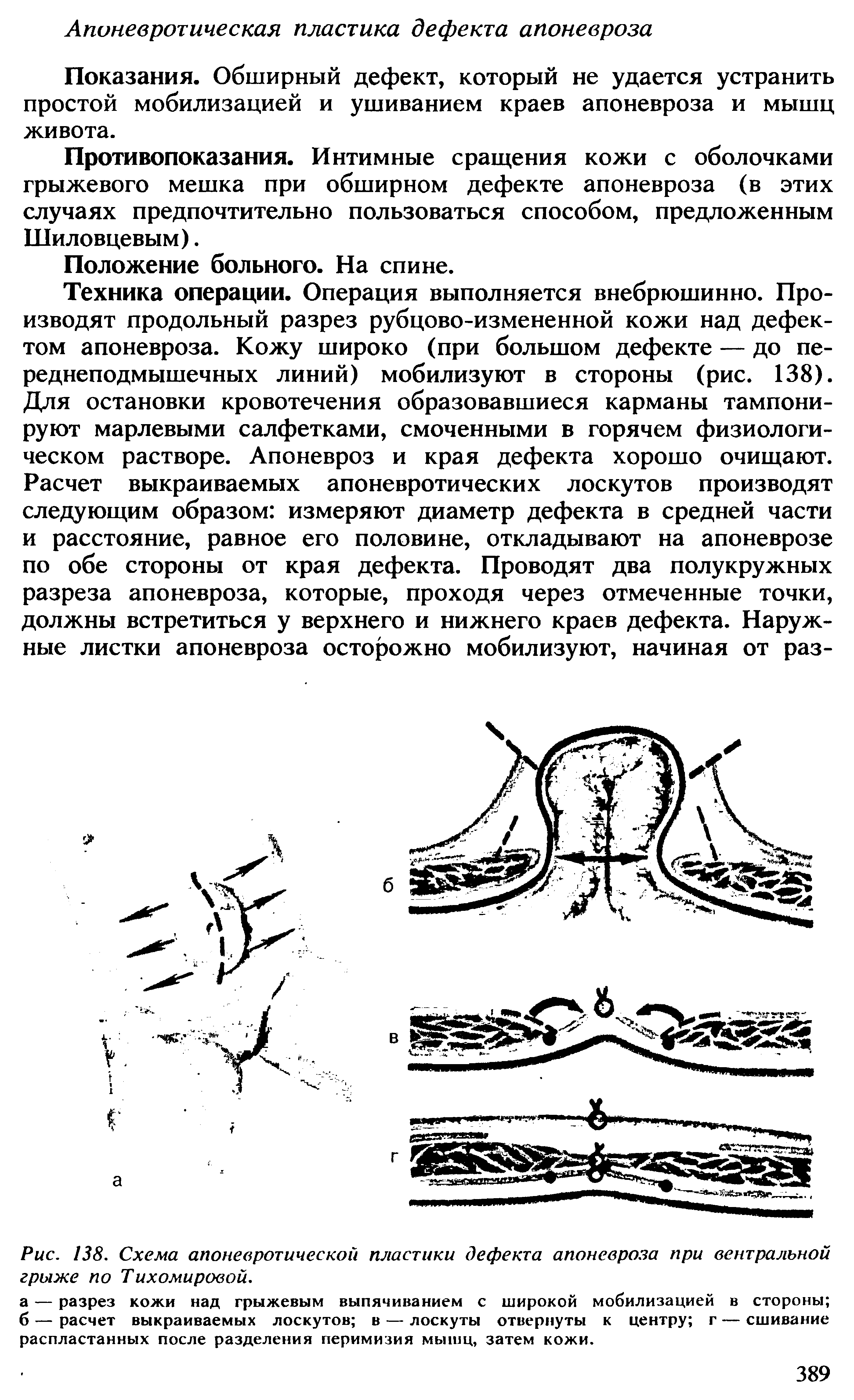 Рис. 138. Схема апоневротической пластики дефекта апоневроза при вентральной грыже по Тихомировой.