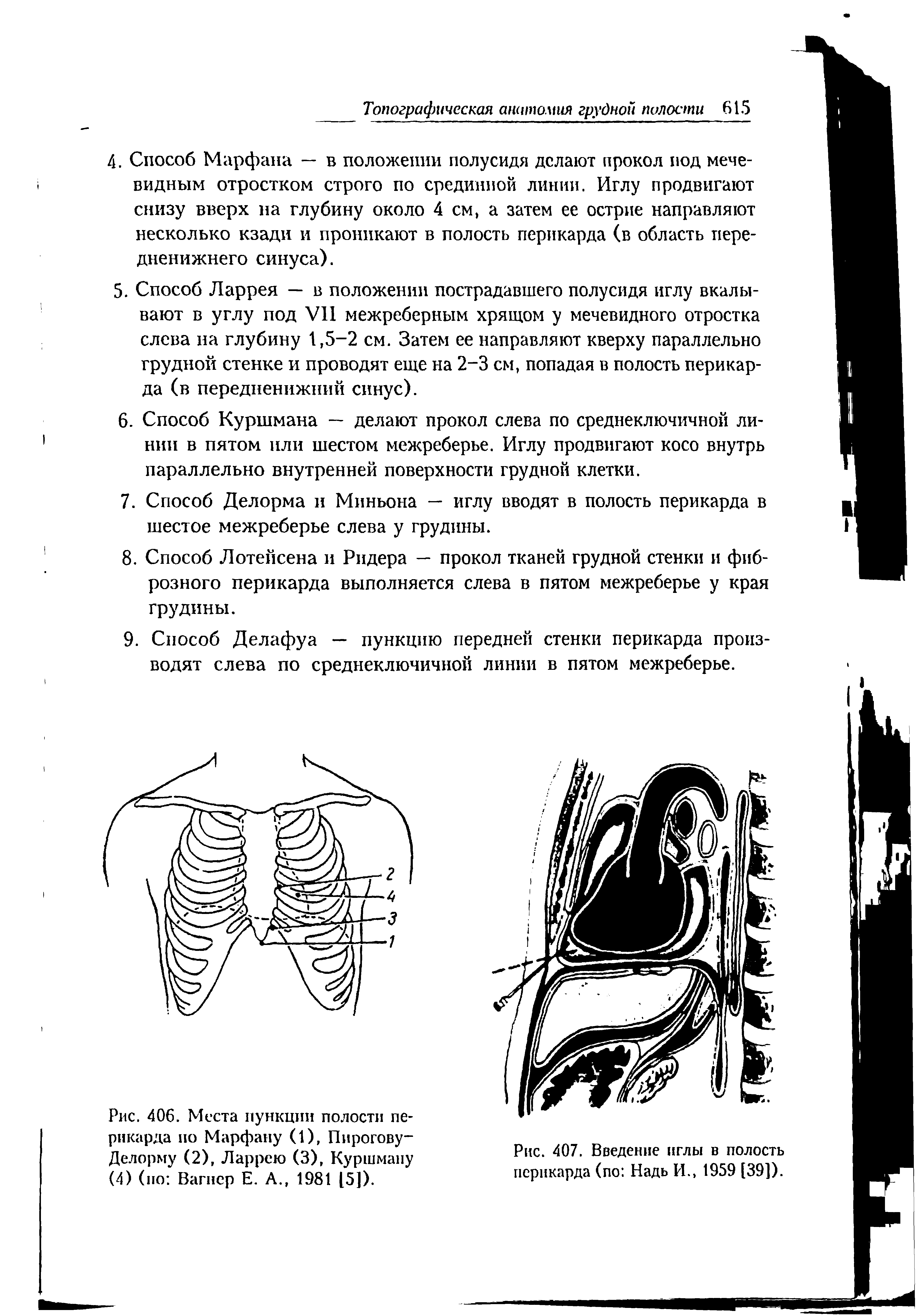 Рис. 406. Места пункции полости перикарда по Марфану (1), Пирогову-Делорму (2), Ларрею (3), Куршману (4) (по Вагнер Е. А., 1981 15]).