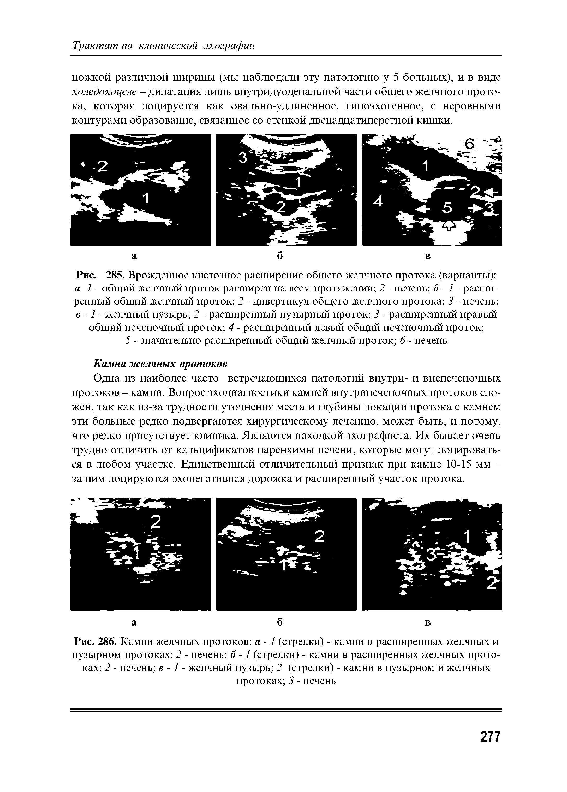 Рис. 285. Врожденное кистозное расширение общего желчного протока (варианты) а -1 - общий желчный проток расширен на всем протяжении 2 - печень б - 1 - расширенный общий желчный проток 2 - дивертикул общего желчного протока 3 - печень в - 1 - желчный пузырь 2 - расширенный пузырный проток 3 - расширенный правый общий печеночный проток 4 - расширенный левый общий печеночный проток ...