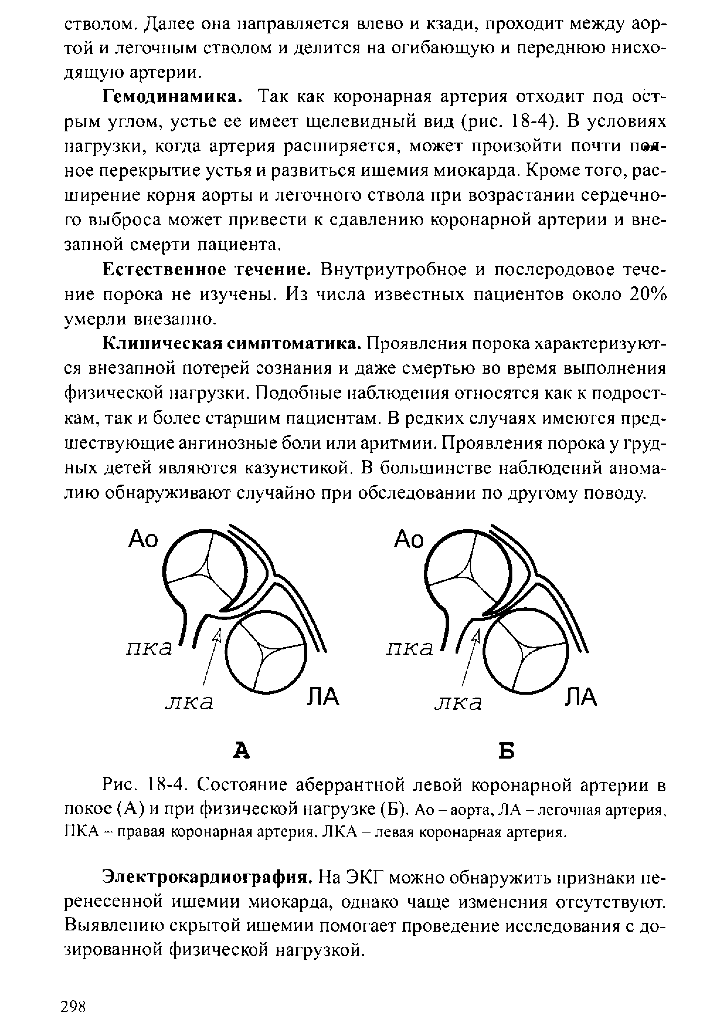 Рис. 18-4. Состояние аберрантной левой коронарной артерии в покое (А) и при физической нагрузке (Б). Ао-аорта, ЛА - легочная артерия, ПКА - правая коронарная артерия. ЛКА - левая коронарная артерия.