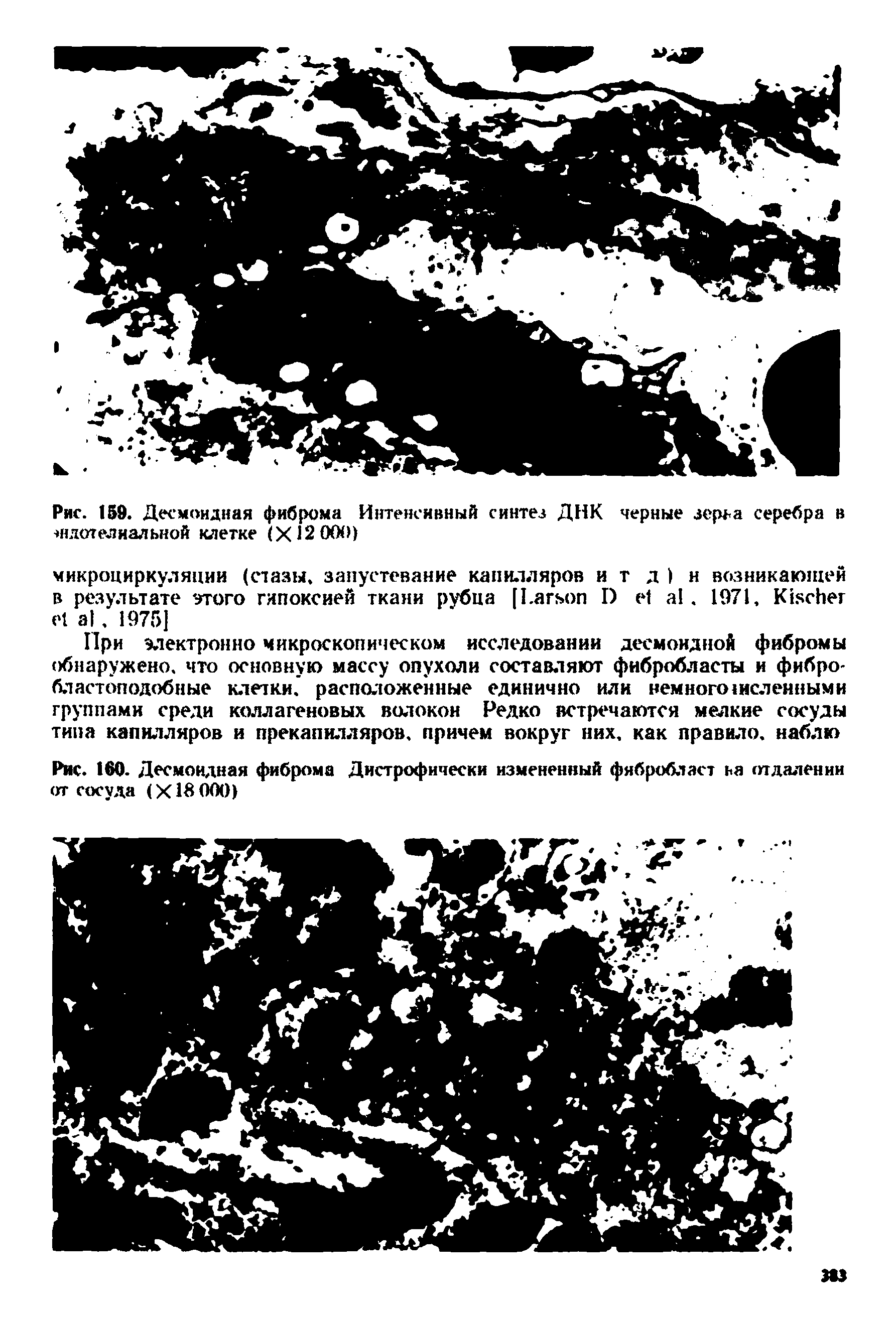 Рис. 159. Десмоидиая фиброма Интенсивный синтез ДНК черные зерна серебра в чшиелиальной клетке (X12 000)...