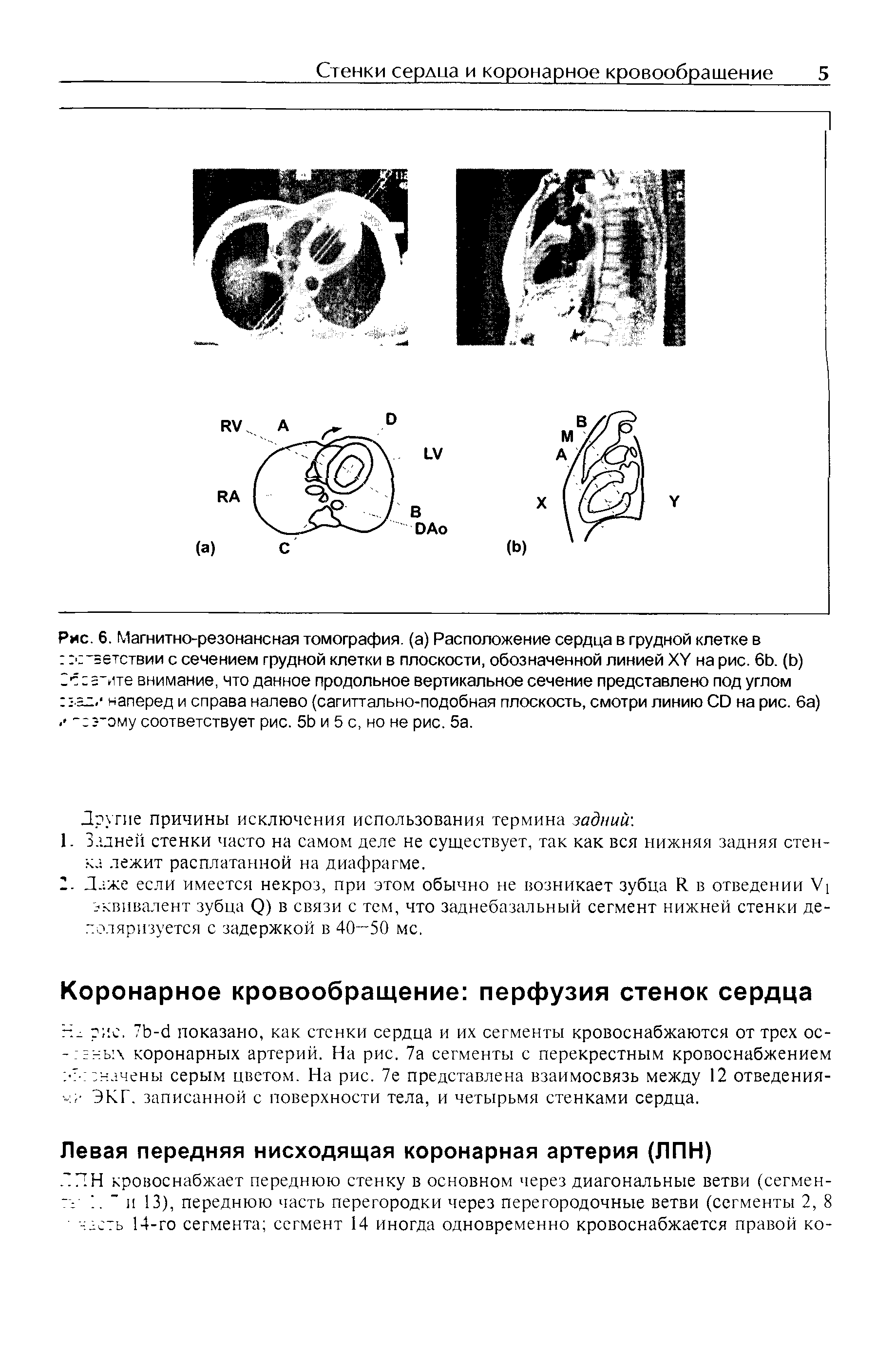 Рис. 6. Магнитно-резонансная томография, (а) Расположение сердца в грудной клетке в...