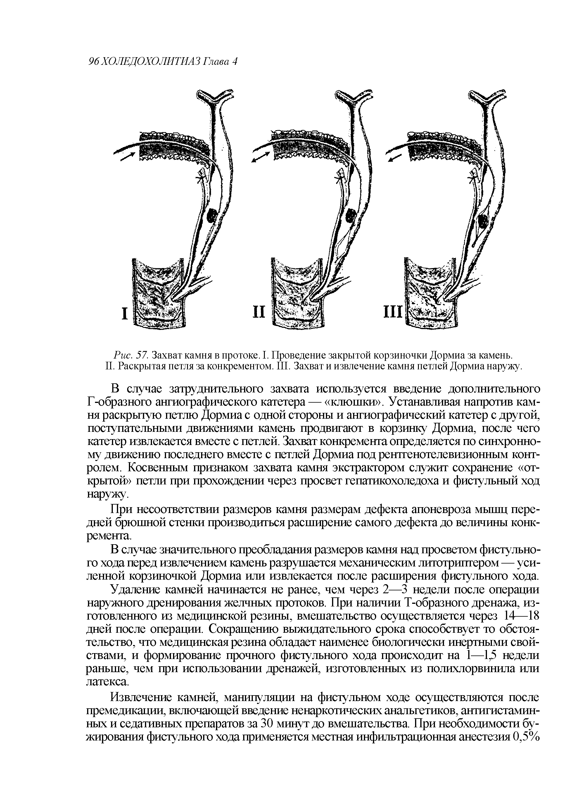 Рис. 57. Захват камня в протоке. I. Проведение закрытой корзиночки Дормиа за камень. II. Раскрытая петля за конкрементом. III. Захват и извлечение камня петлей Дормиа наружу.