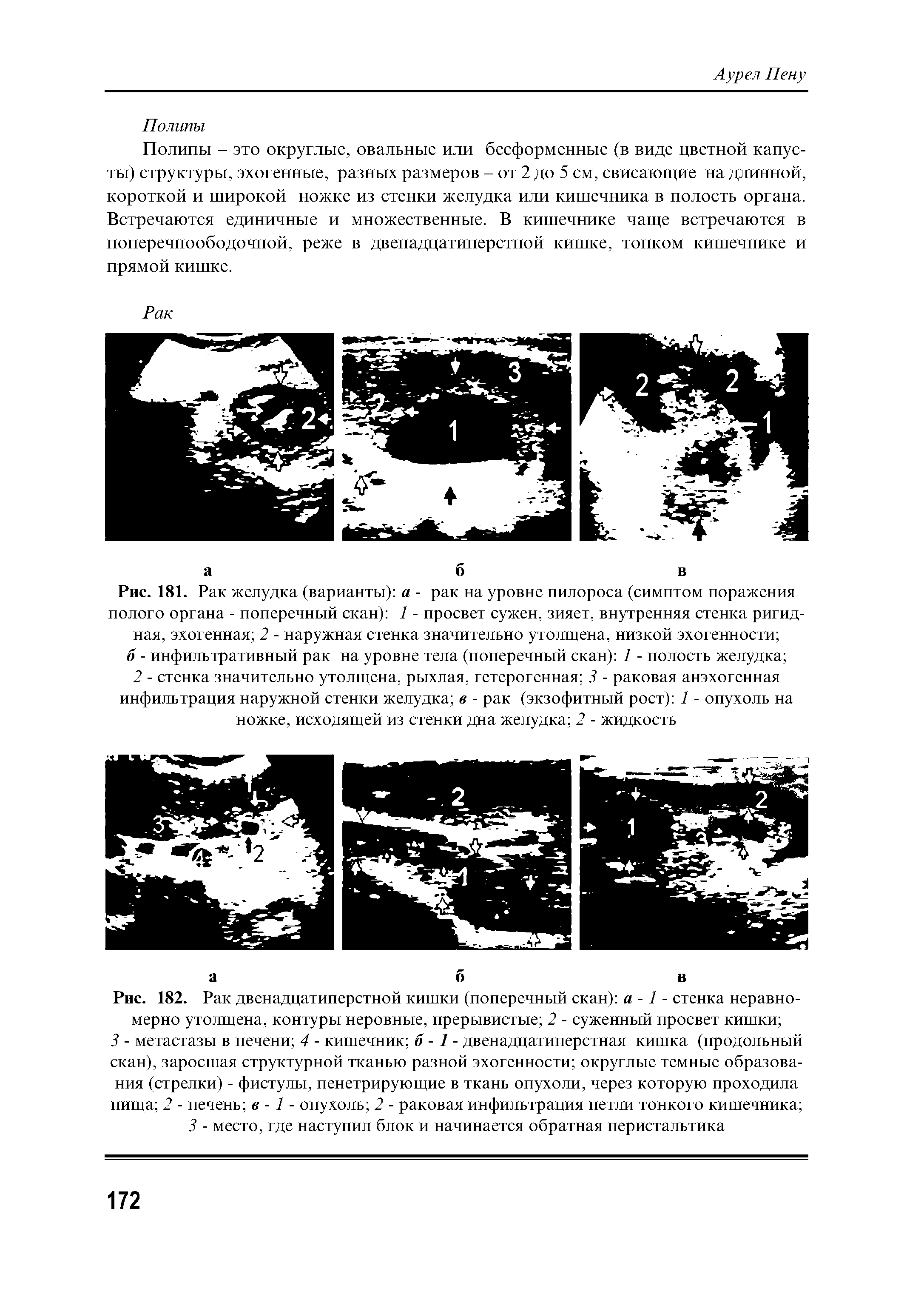 Рис. 181. Рак желудка (варианты) а - рак на уровне пилороса (симптом поражения полого органа - поперечный скан) 1 - просвет сужен, зияет, внутренняя стенка ригидная, эхогенная 2 - наружная стенка значительно утолщена, низкой эхогенности ...