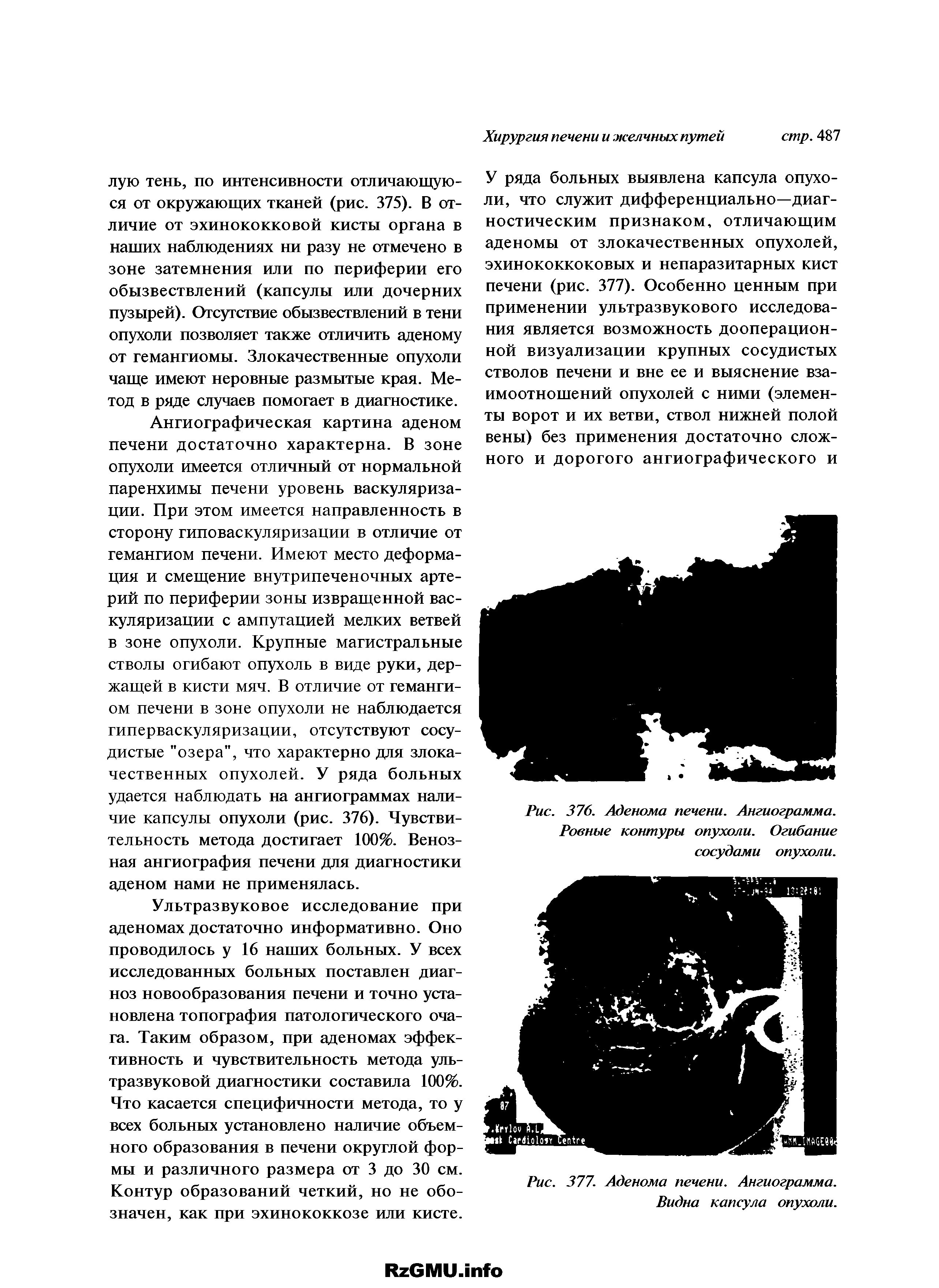 Рис. 376. Аденома печени. Ангиограмма. Ровные контуры опухоли. Огибание сосудами опухоли.