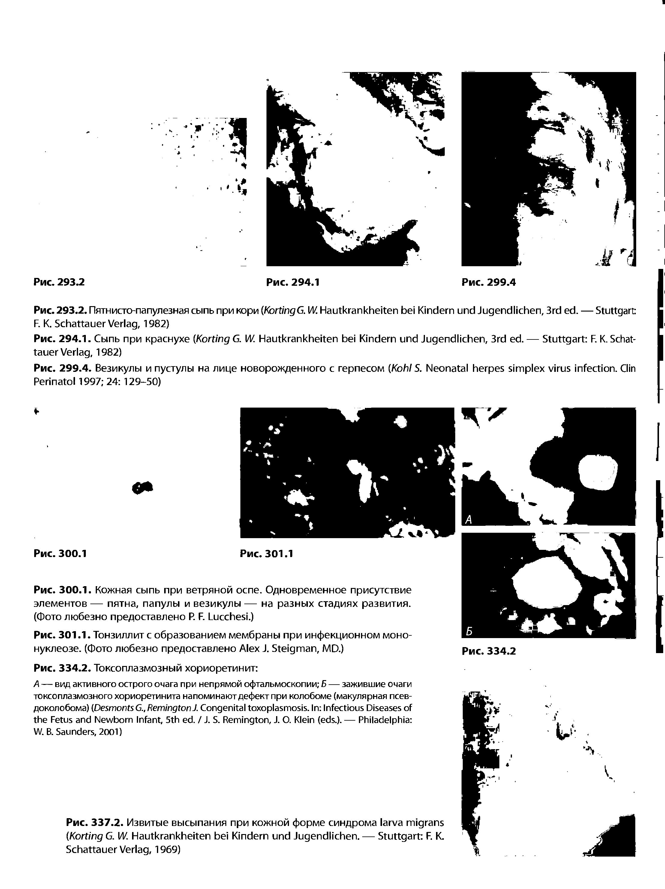 Рис. 337.2. Извитые высыпания при кожной форме синдрома (K G. И/. H K J . — S F. K. S V , 1969)...