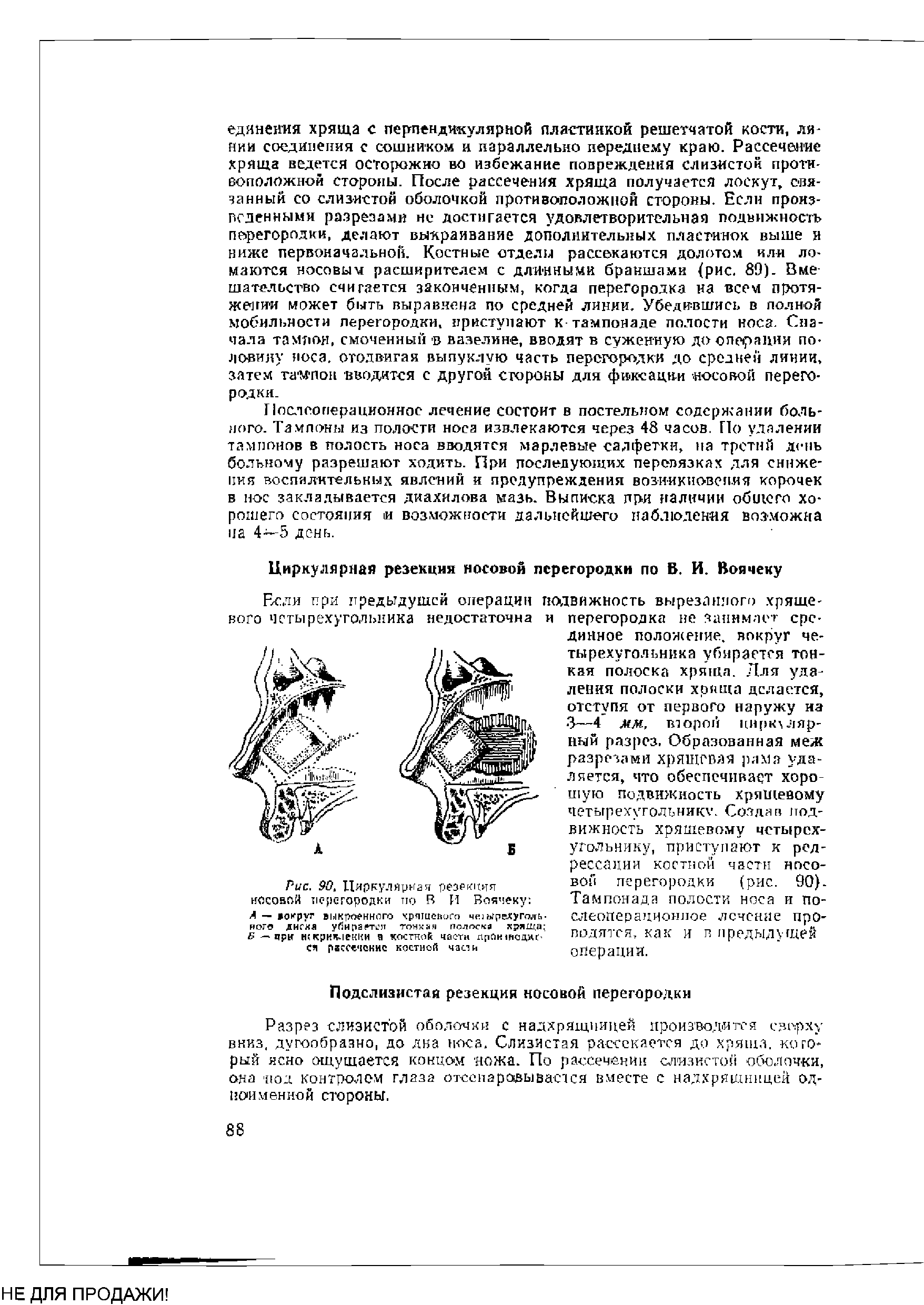 Рис. 90. Циркулярная резекция носовой перегородки по В И Воячеку А — округ выкроенного хрящевого четырехугольного диске убирается тонкая полоска хряща Б — яри н(кркв-1екки я костной части лпотнеднг-ся рассечение костной части...