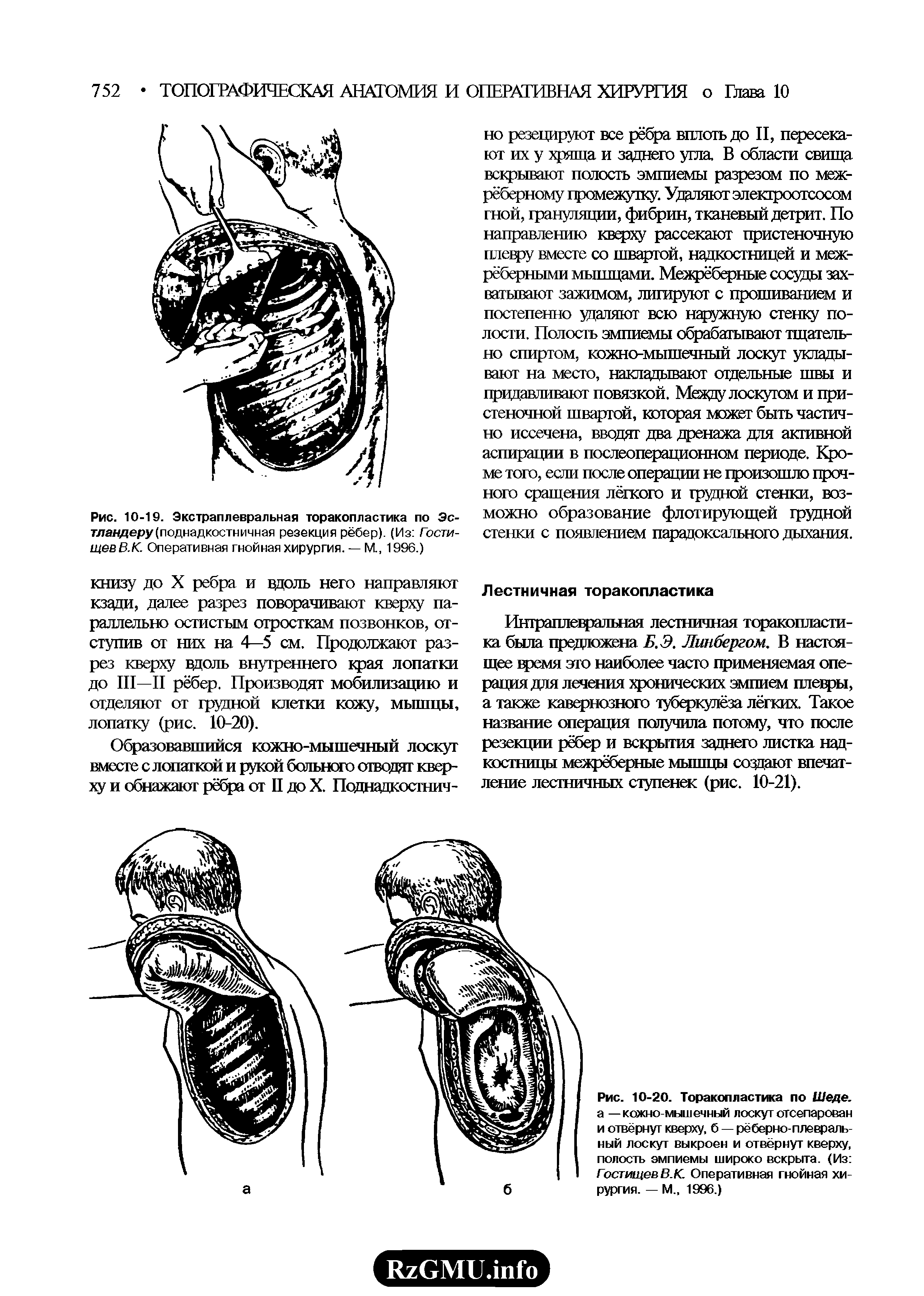 Рис. 10-19. Экстраплевральная торакопластика по Эс-тландеру (поднадкостничная резекция рёбер). (Из Гости-щевВ.К. Оперативная гнойная хирургия. — М., 1996.)...