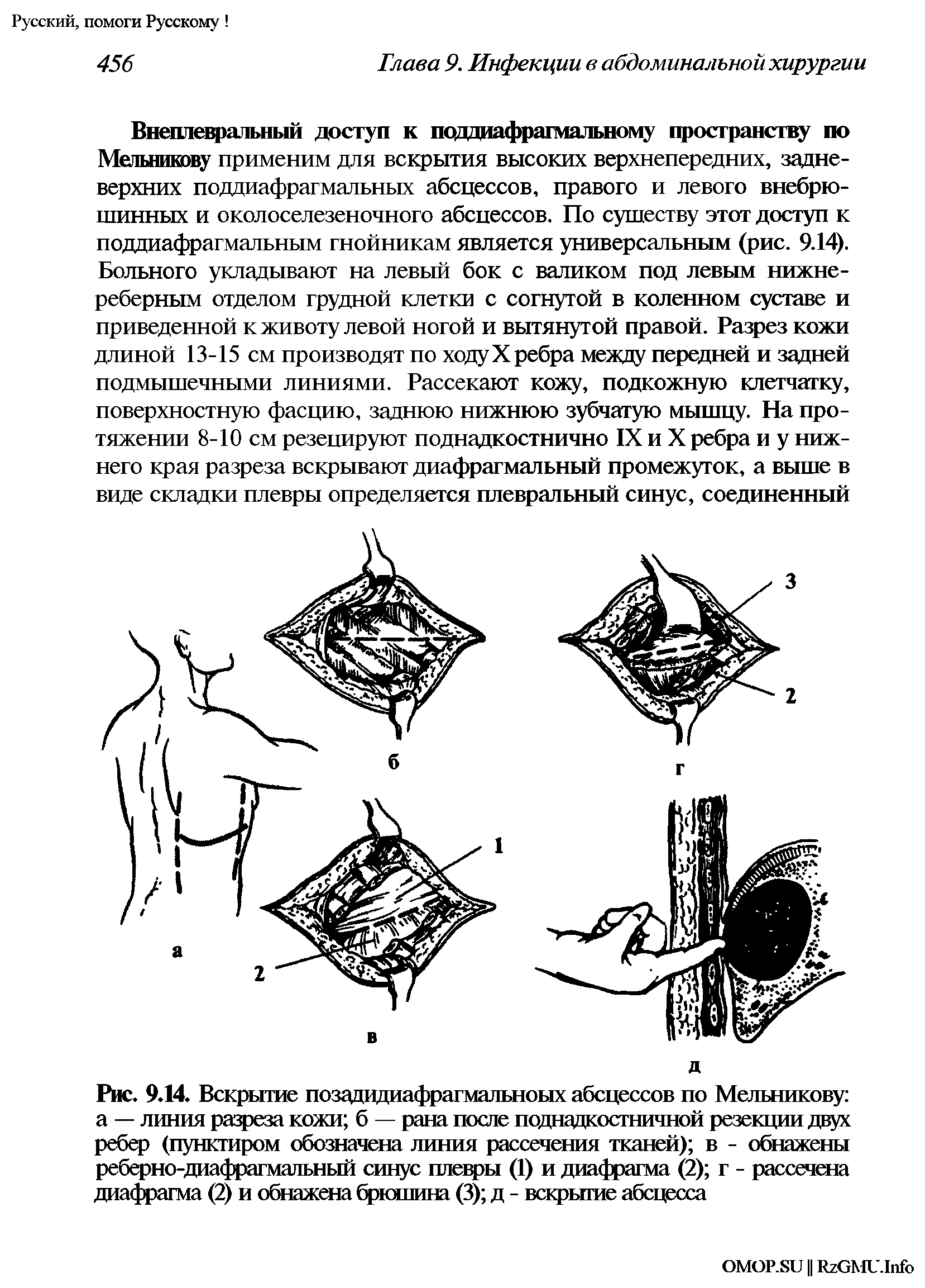 Рис. 9.14. Вскрытие позадидиафрагмальноых абсцессов по Мельникову а — линия разреза кожи б — рана после поднадкостничной резекции двух ребер (пунктиром обозначена линия рассечения тканей) в - обнажены реберно-диафрагмальный синус плевры (1) и диафрагма (2) г - рассечена диафрагма (2) и обнажена брюшина (3) д - вскрытие абсцесса...