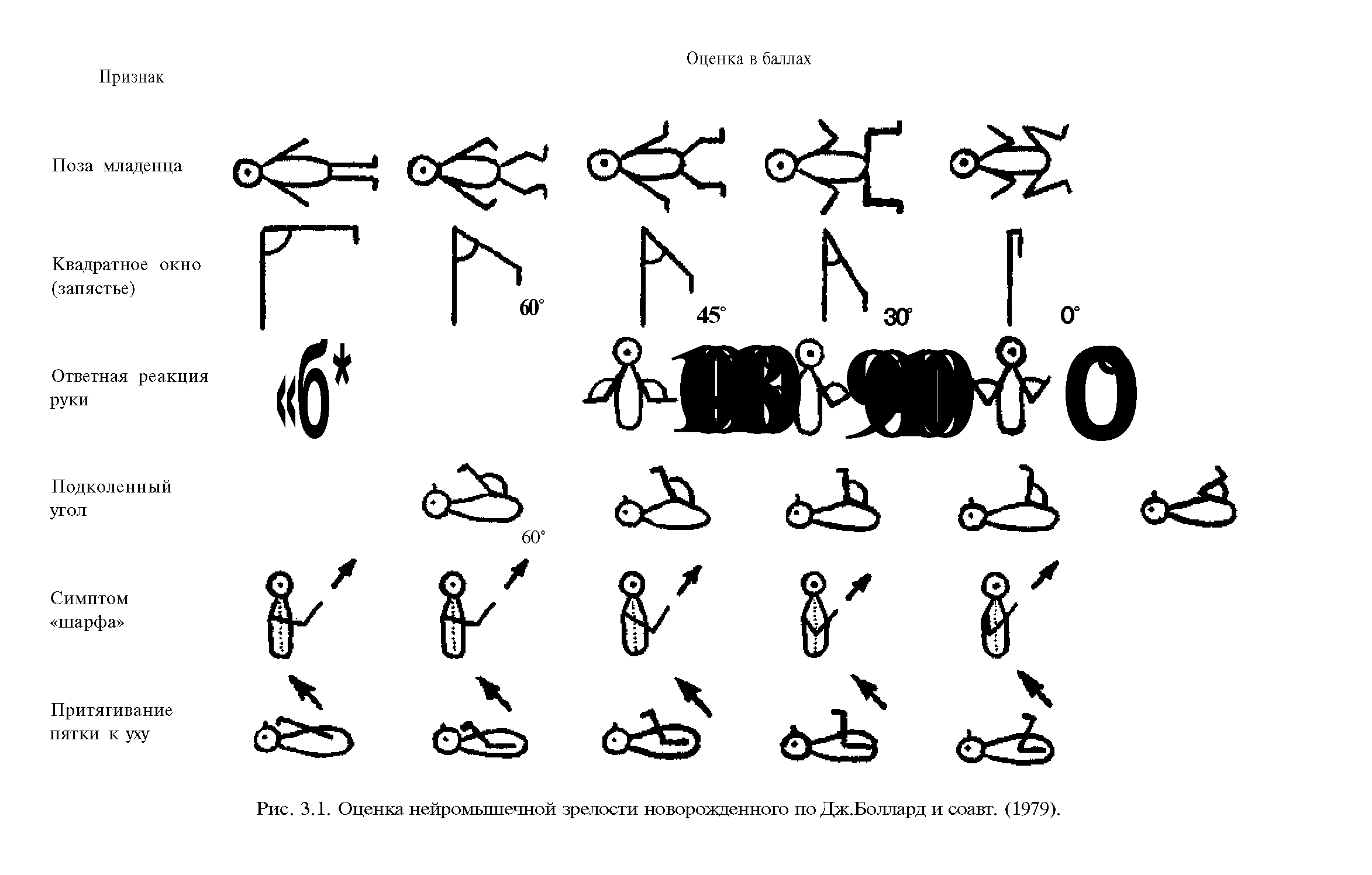 Рис. 3.1. Оценка нейромышечной зрелости новорожденного по Дж.Боллард и соавт. (1979).
