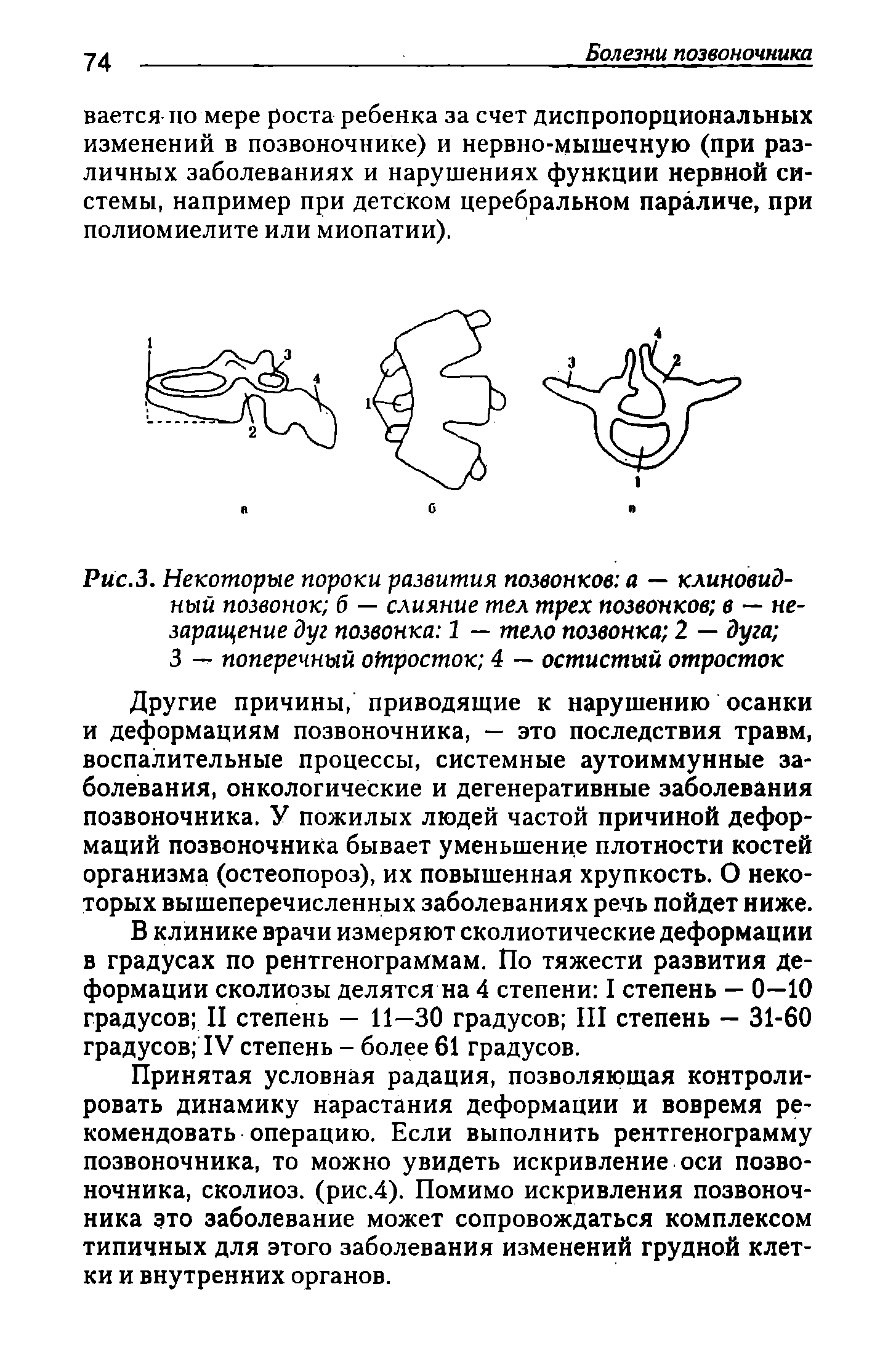 Рис.З. Некоторые пороки развития позвонков а — клиновидный позвонок б — слияние тел трех позвонков в — не-заращение дуг позвонка 1 — тело позвонка 2 — дуга 3 — поперечный отросток 4 — остистый отросток...