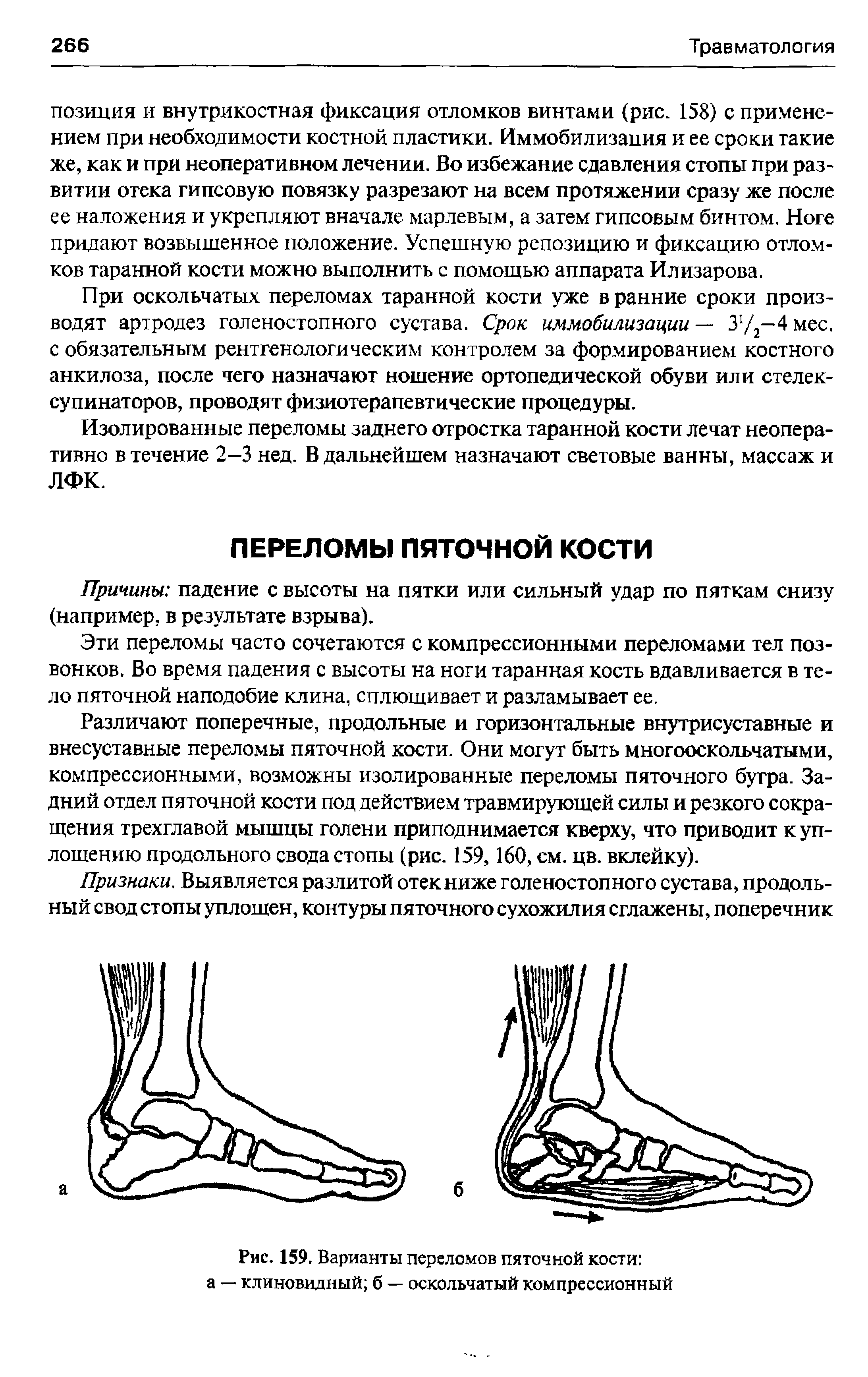 Рис. 159. Варианты переломов пяточной кости а — клиновидный б — оскольчатый компрессионный...