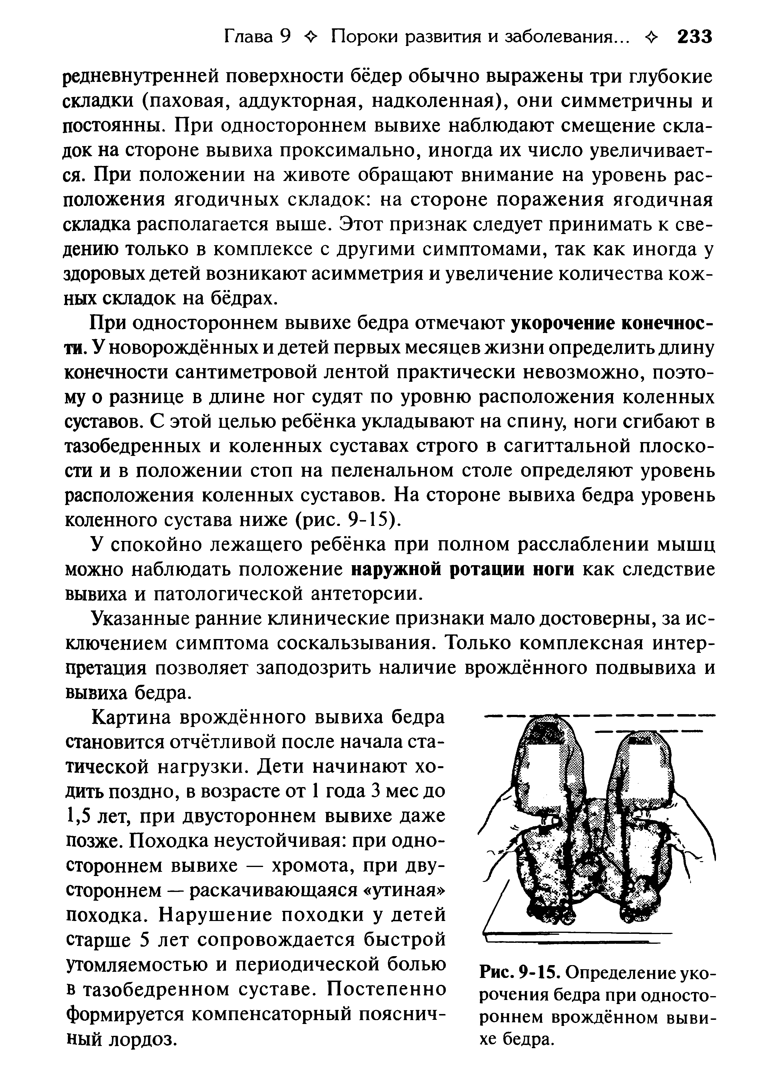 Рис. 9-15. Определение укорочения бедра при одностороннем врождённом вывихе бедра.