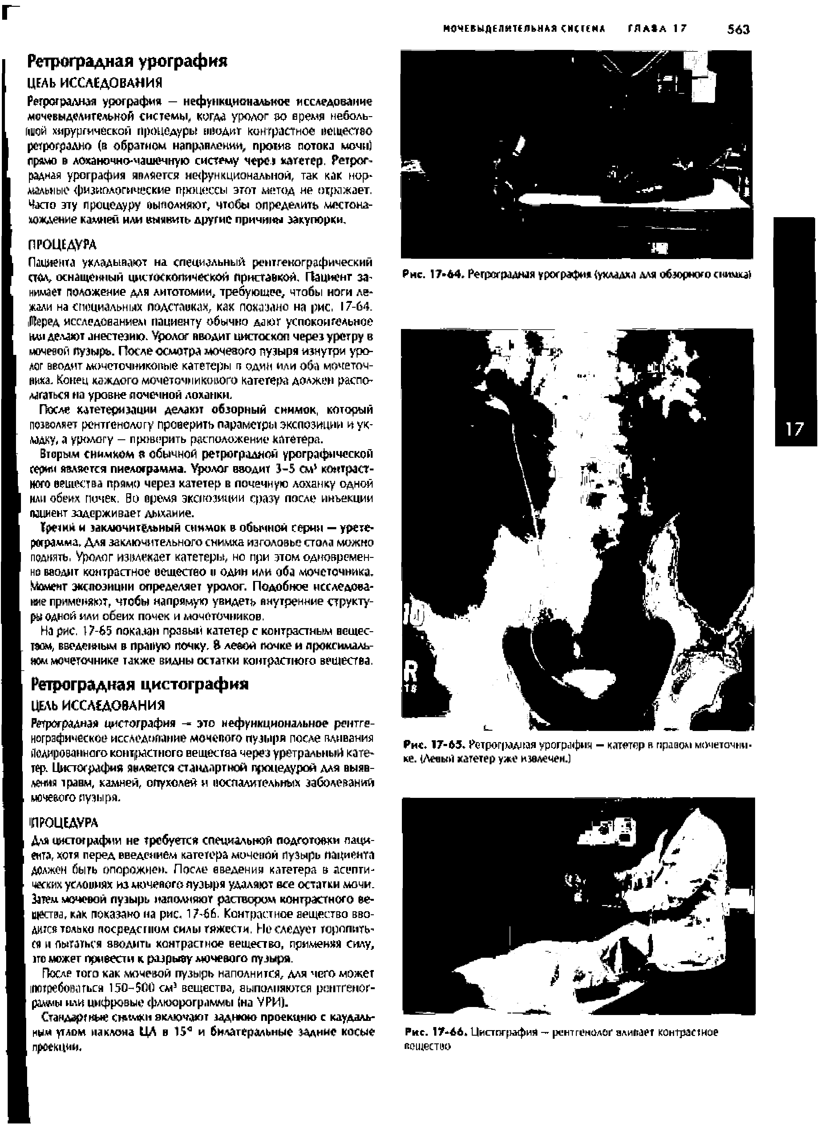 Рис. 17-65. Ретрог мдная урография - катетер в правом мочеточнике. (Левый катетер уже извлечен.)...