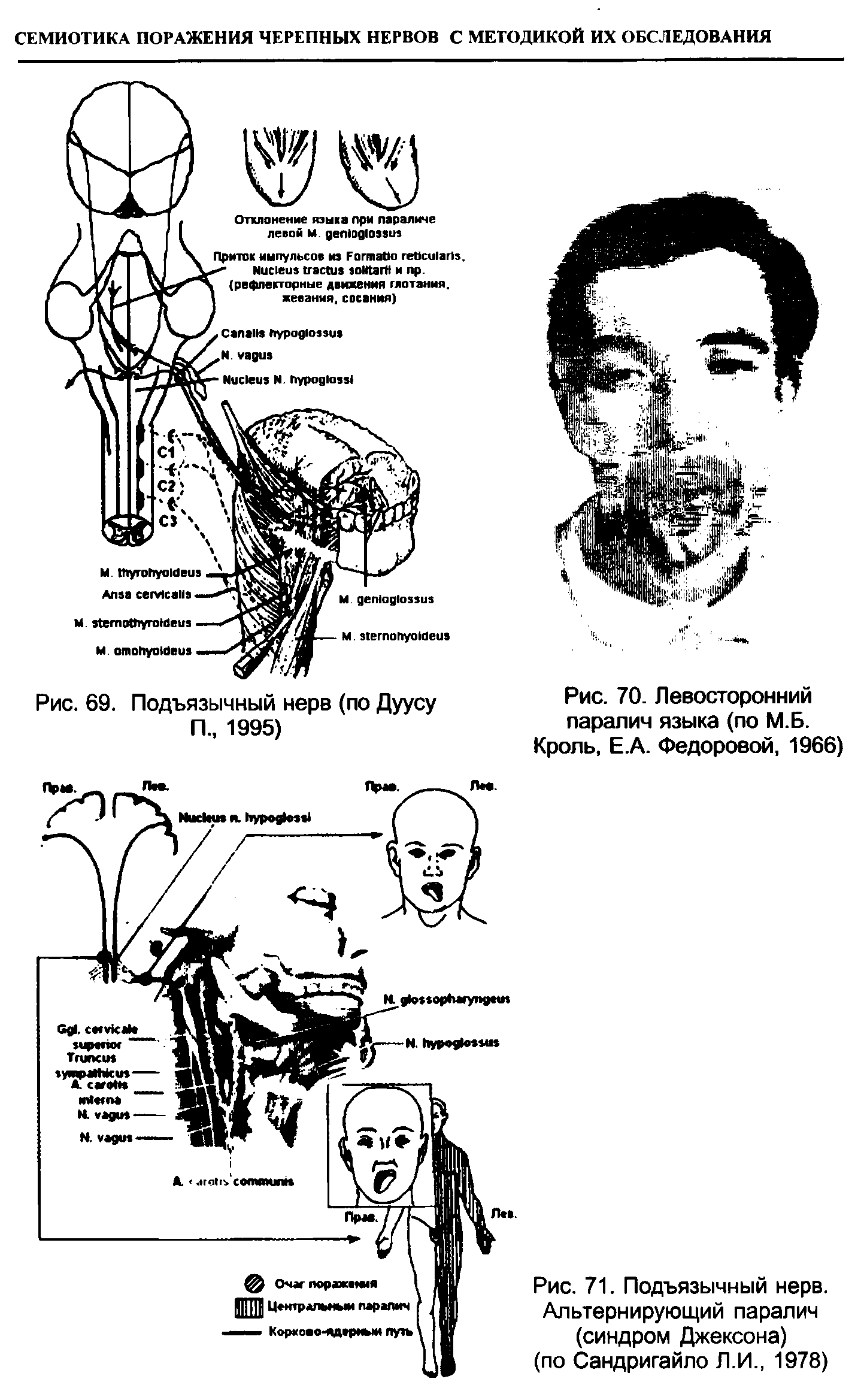 Рис. 71. Подъязычный нерв. Альтернирующий паралич (синдром Джексона)...