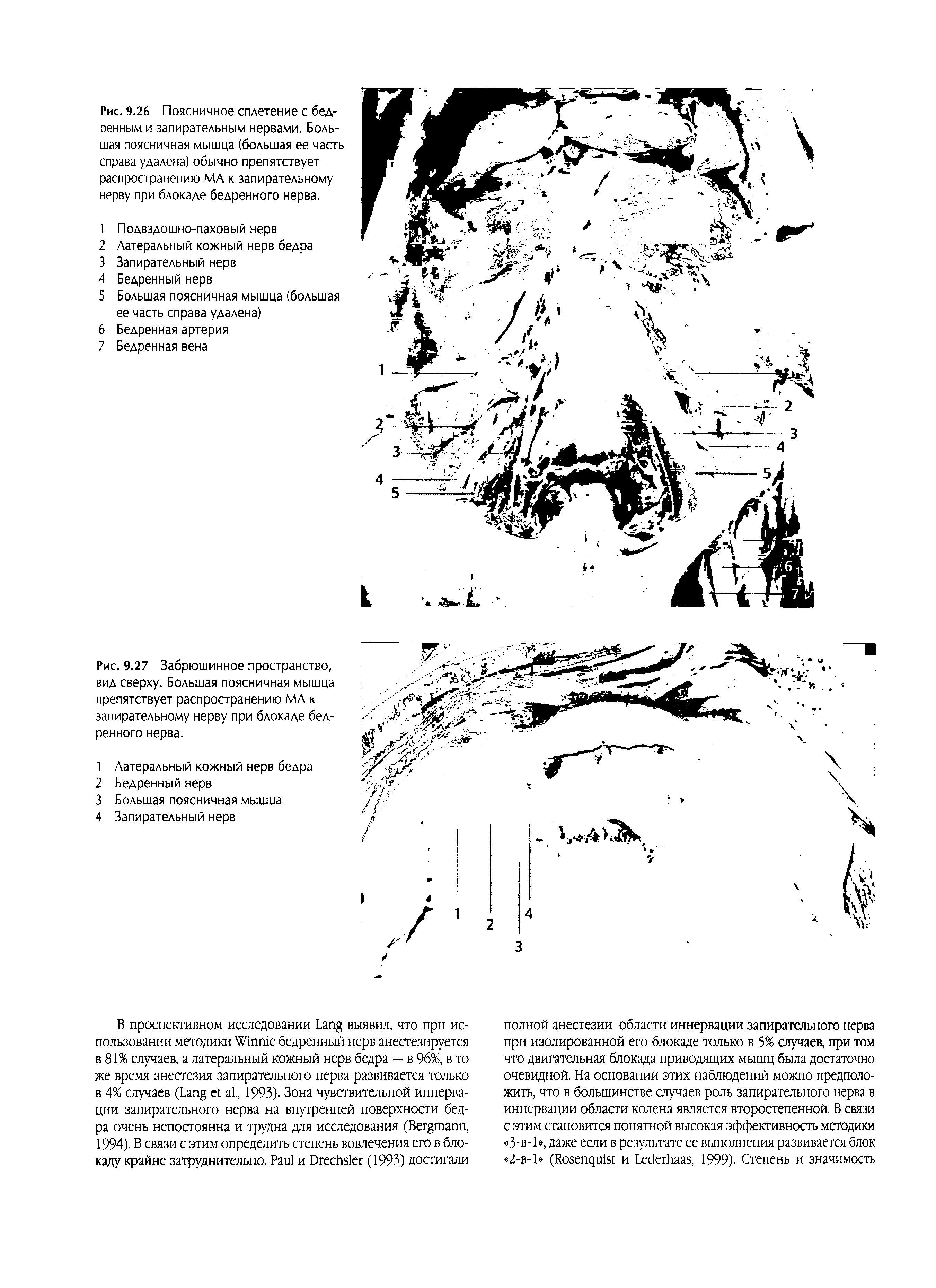 Рис. 9.27 Забрюшинное пространство, вид сверху. Большая поясничная мышца препятствует распространению МА к запирательному нерву при блокаде бедренного нерва.