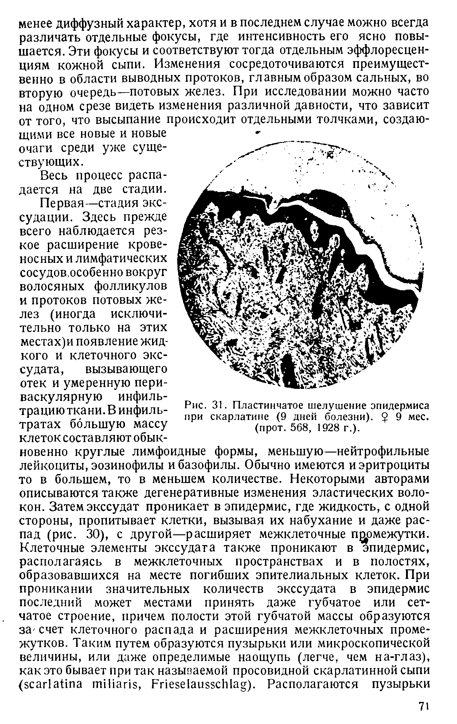 Рис. 31. Пластинчатое шелушение эпидермиса при скарлатине (9 дней болезни). 9 мес. (прот. 568, 1928 г.).