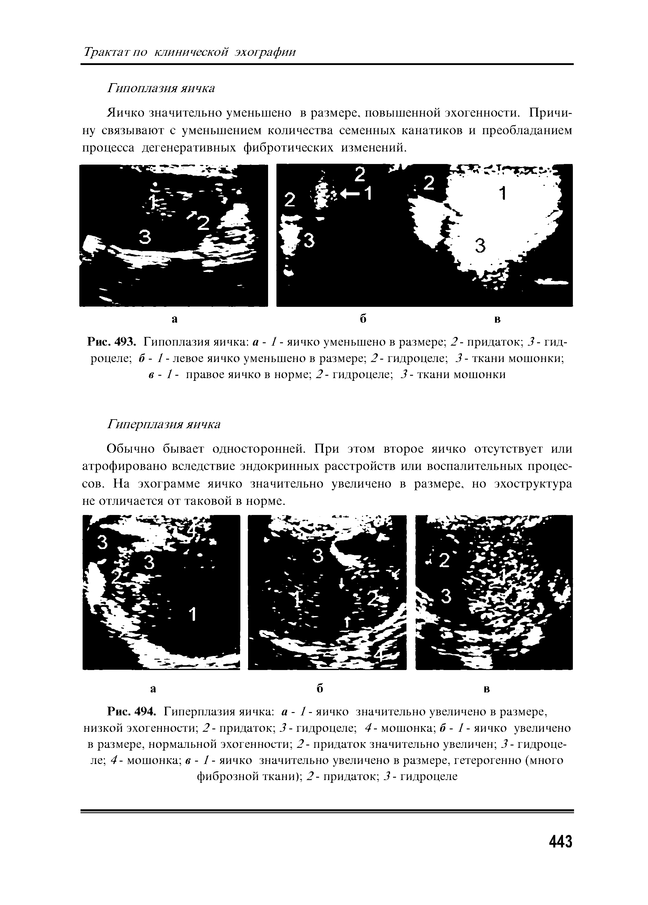 Рис. 494. Гиперплазия яичка а- /-яичко значительно увеличено в размере, низкой эхогенности 2 - придаток 3 - гидроцеле 4- мошонка б - 1 - яичко увеличено в размере, нормальной эхогенности 2- придаток значительно увеличен 3- гидроцеле 4- мошонка в - 1 - яичко значительно увеличено в размере, гетерогенно (много фиброзной ткани) 2- придаток 3- гидроцеле...