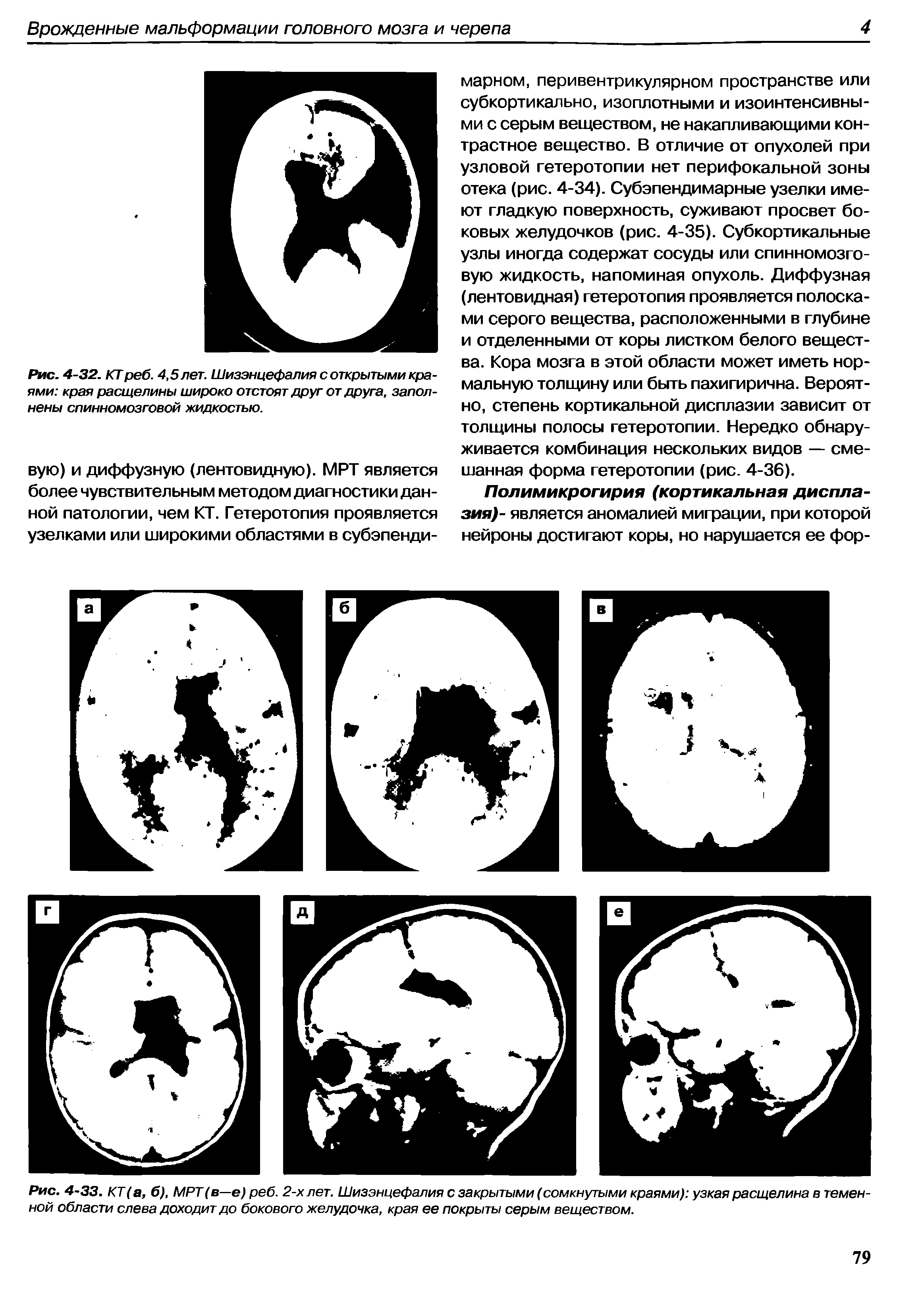 Рис. 4-33. КТ(а, б), МРТ(в—е) реб. 2-х лет. Шизэнцефалия с закрытыми (сомкнутыми краями) узкая расщелина в теменной области слева доходит до бокового желудочка, края ее покрыты серым веществом.