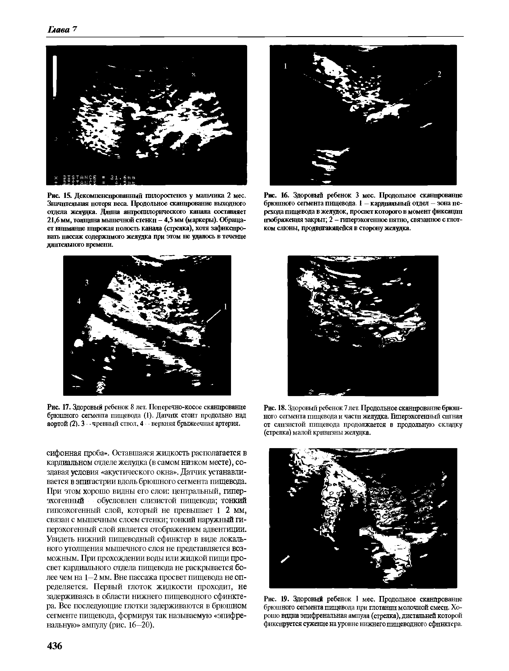 Рис. 19. Здоровый ребенок 1 мес. Продольное сканирование брюшного сегмента пищевода при глотании молочной смеси. Хорошо видна эпифренальная ампула (стрелка), дистальней которой фиксируется сужение на уровне нижнего пищеводного сфинктера.