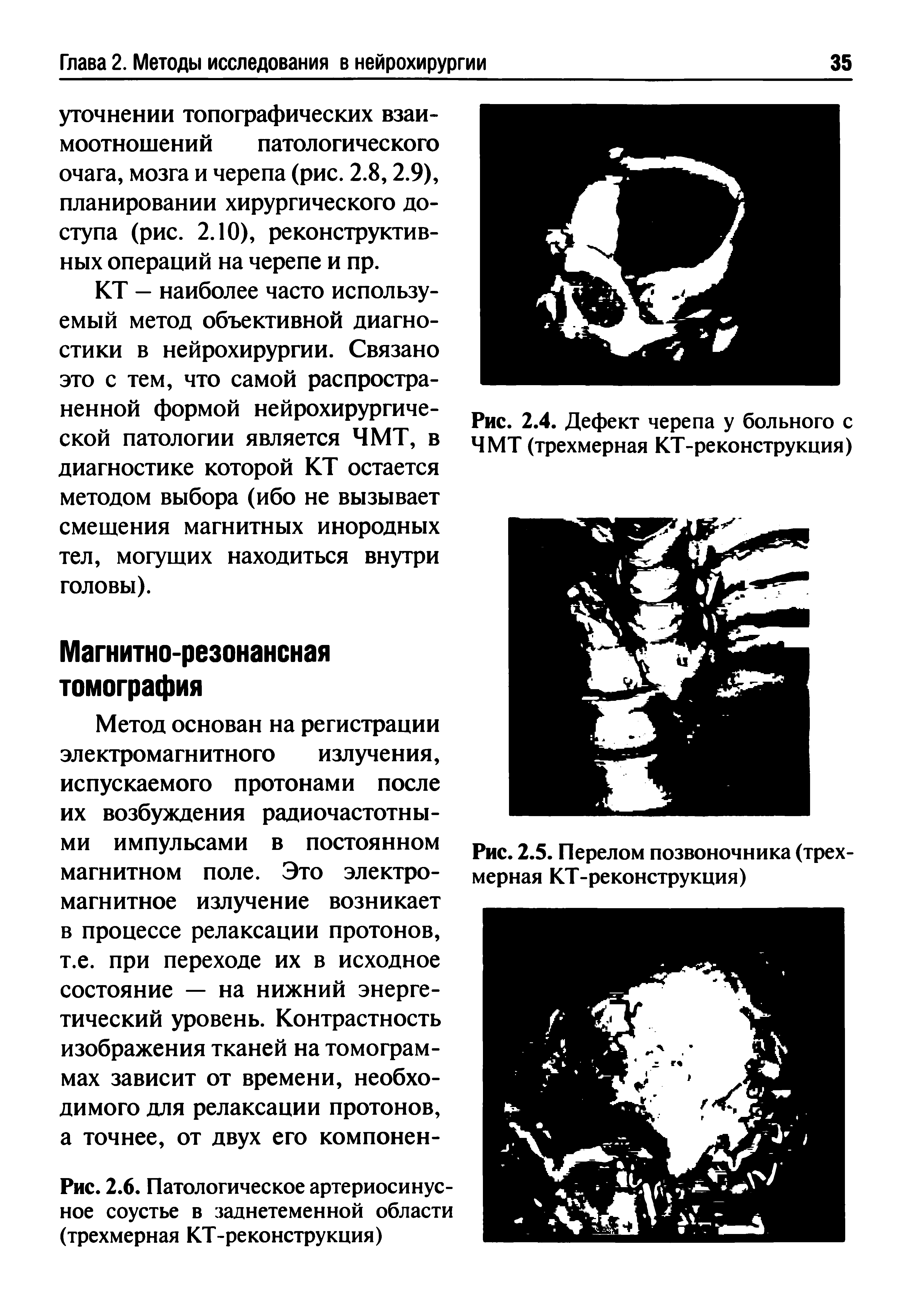 Рис. 2.6. Патологическое артериосинусное соустье в заднетеменной области (трехмерная КТ-реконструкция)...