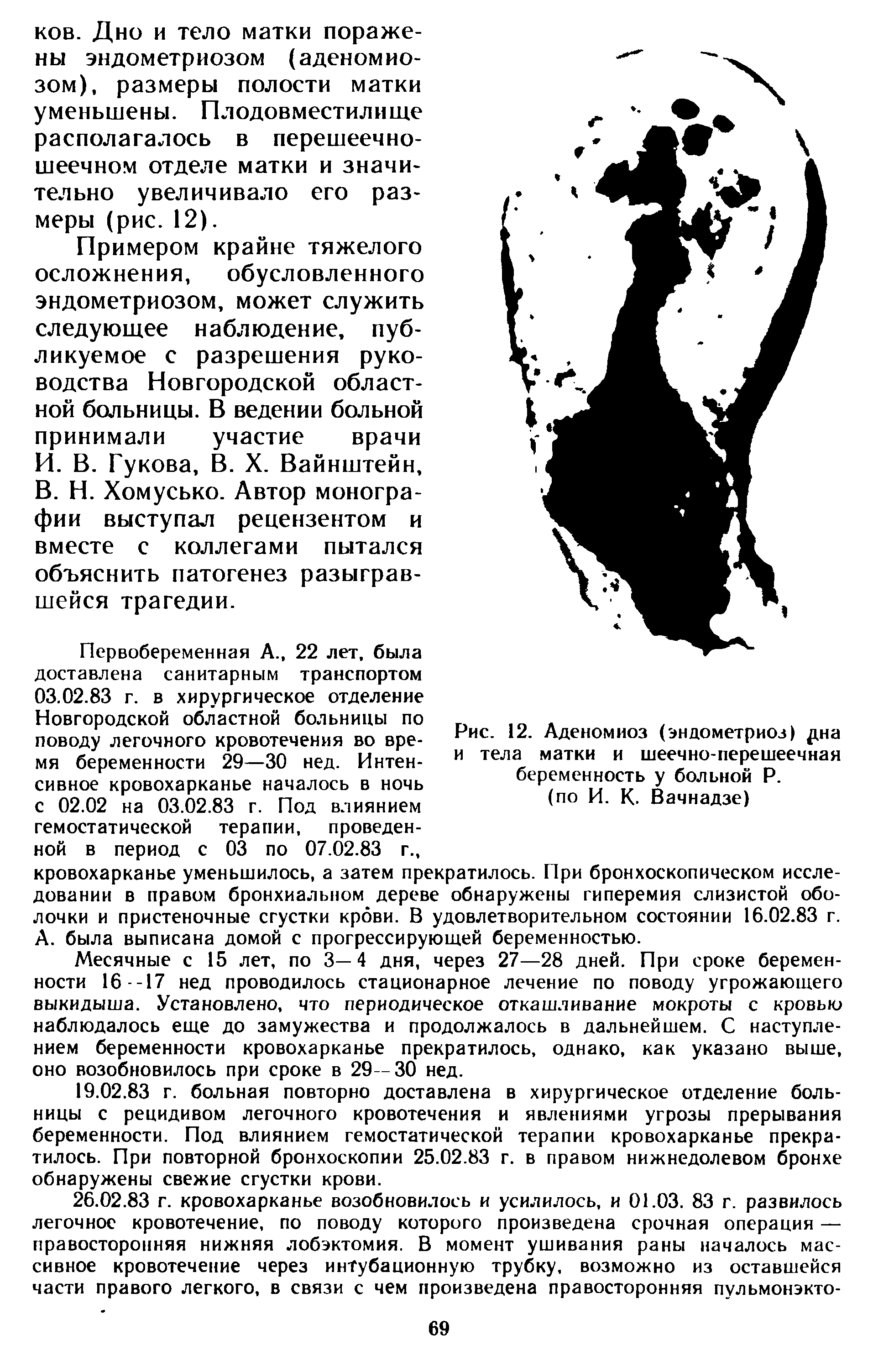 Рис. 12. Аденомиоз (эндометриоз) ща и тела матки и шеечно-перешеечная беременность у больной Р.