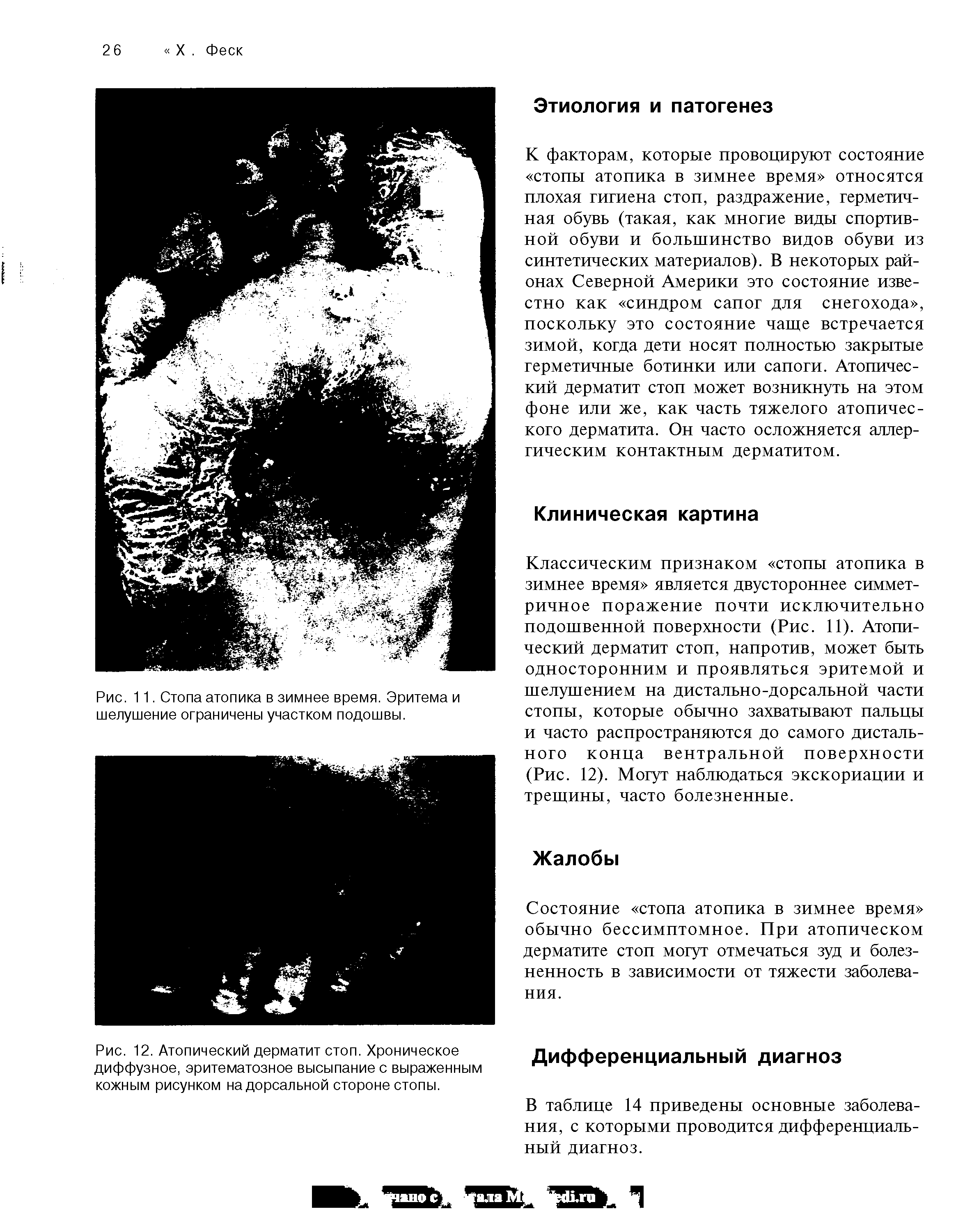 Рис. 12. Атопический дерматит стоп. Хроническое диффузное, эритематозное высыпание с выраженным кожным рисунком на дорсальной стороне стопы.