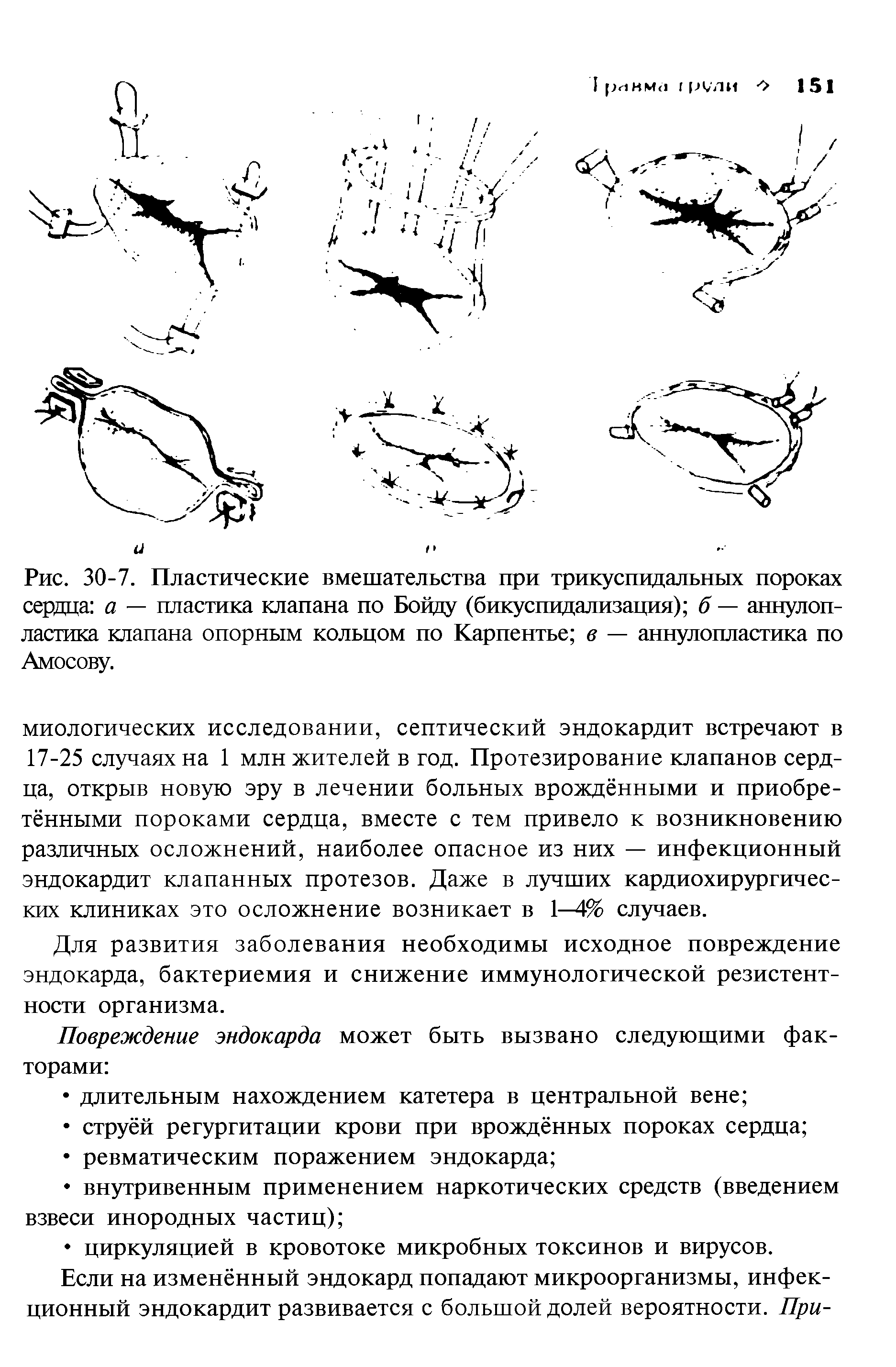 Рис. 30-7. Пластические вмешательства при трикуспидальных пороках сердца а — пластика клапана по Бойду (бикуспидализация) б — аннулоп-ластика клапана опорным кольцом по Карпентье в — аннулопластика по Амосову.