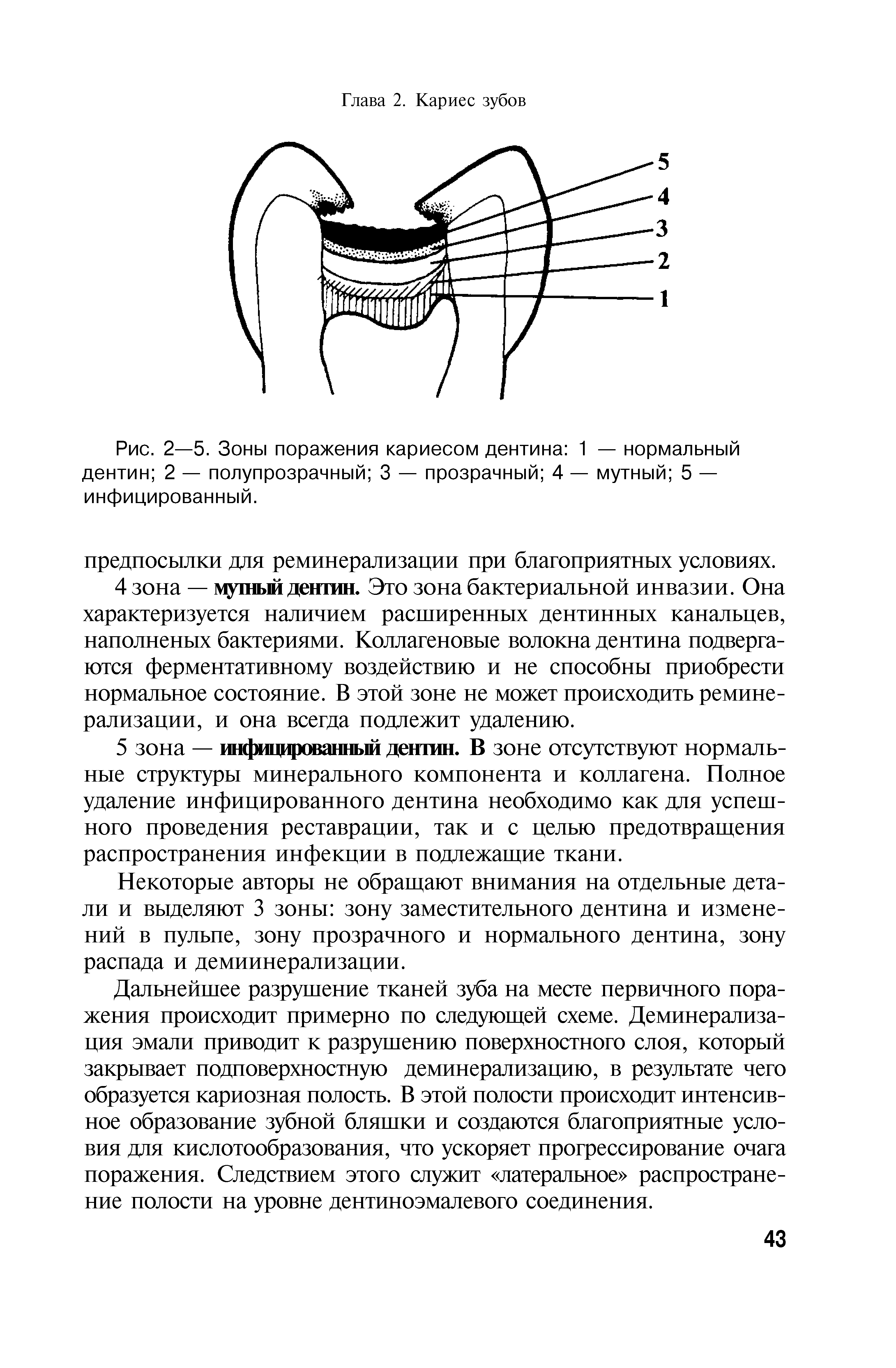 Рис. 2—5. Зоны поражения кариесом дентина 1 — нормальный дентин 2 — полупрозрачный 3 — прозрачный 4 — мутный 5 — инфицированный.