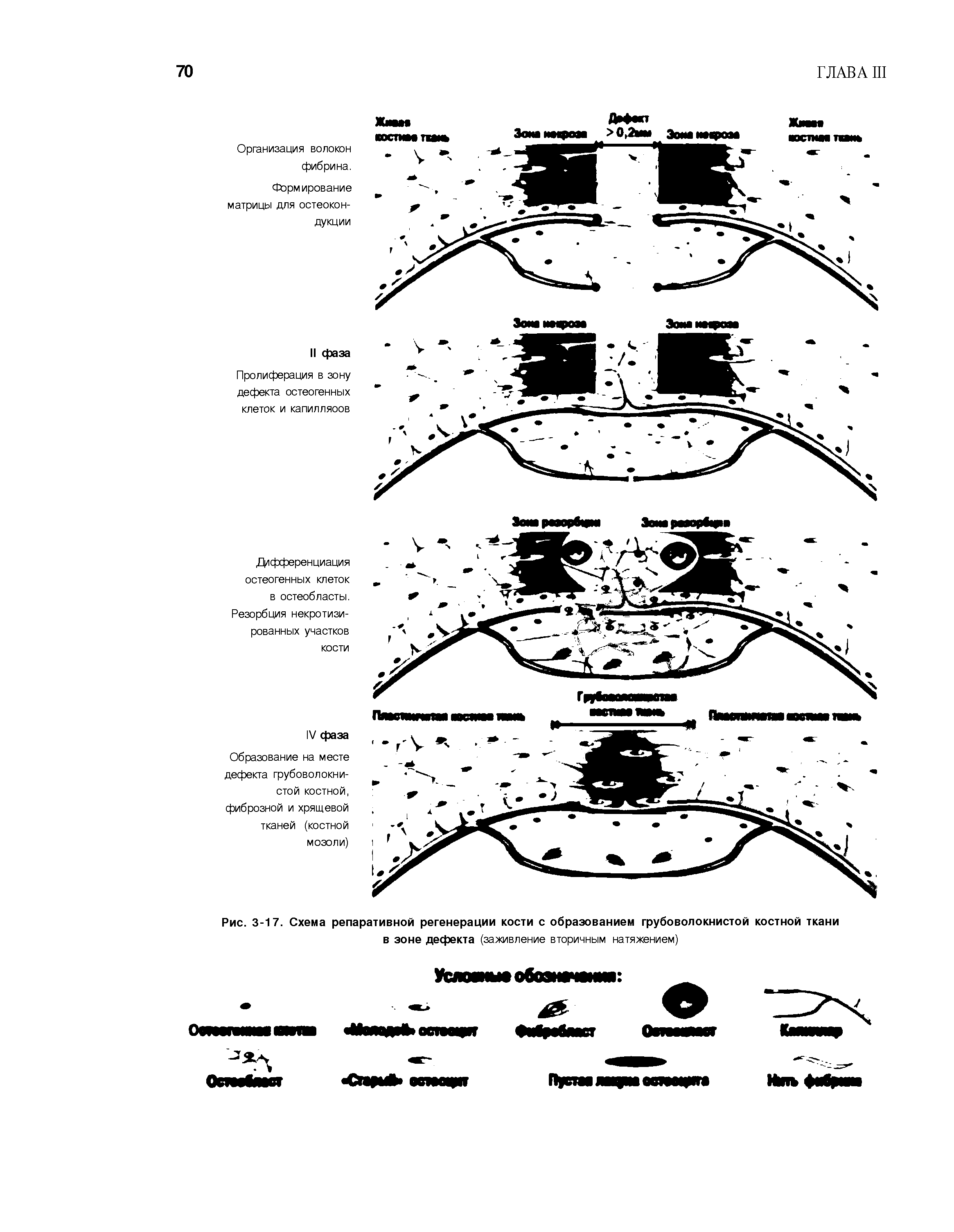 Рис. 3-17. Схема репаративной регенерации кости с образованием грубоволокнистой костной ткани...