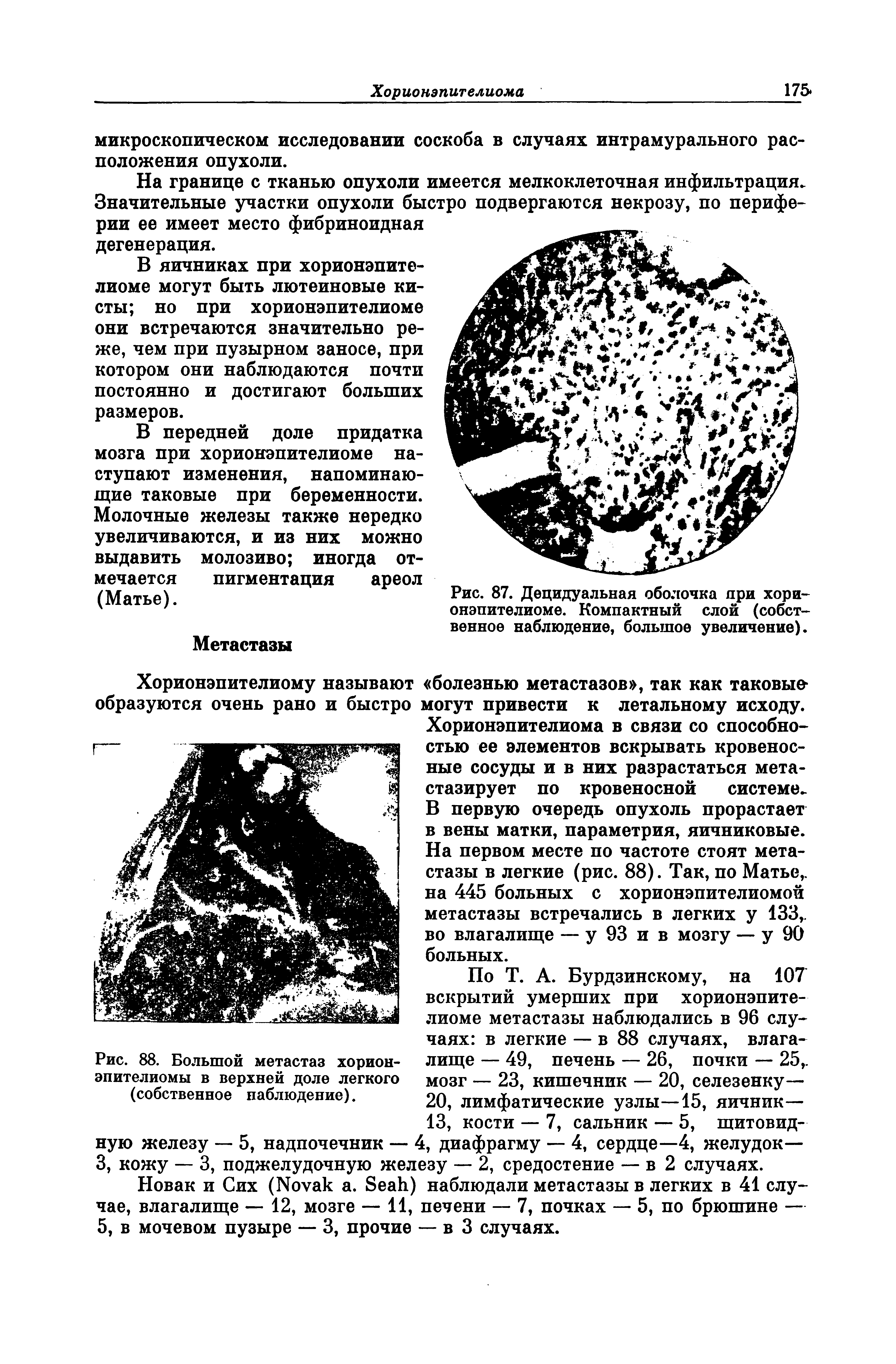 Рис. 87. Децидуальная оболочка при хорионэпителиоме. Компактный слой (собственное наблюдение, большое увеличение).