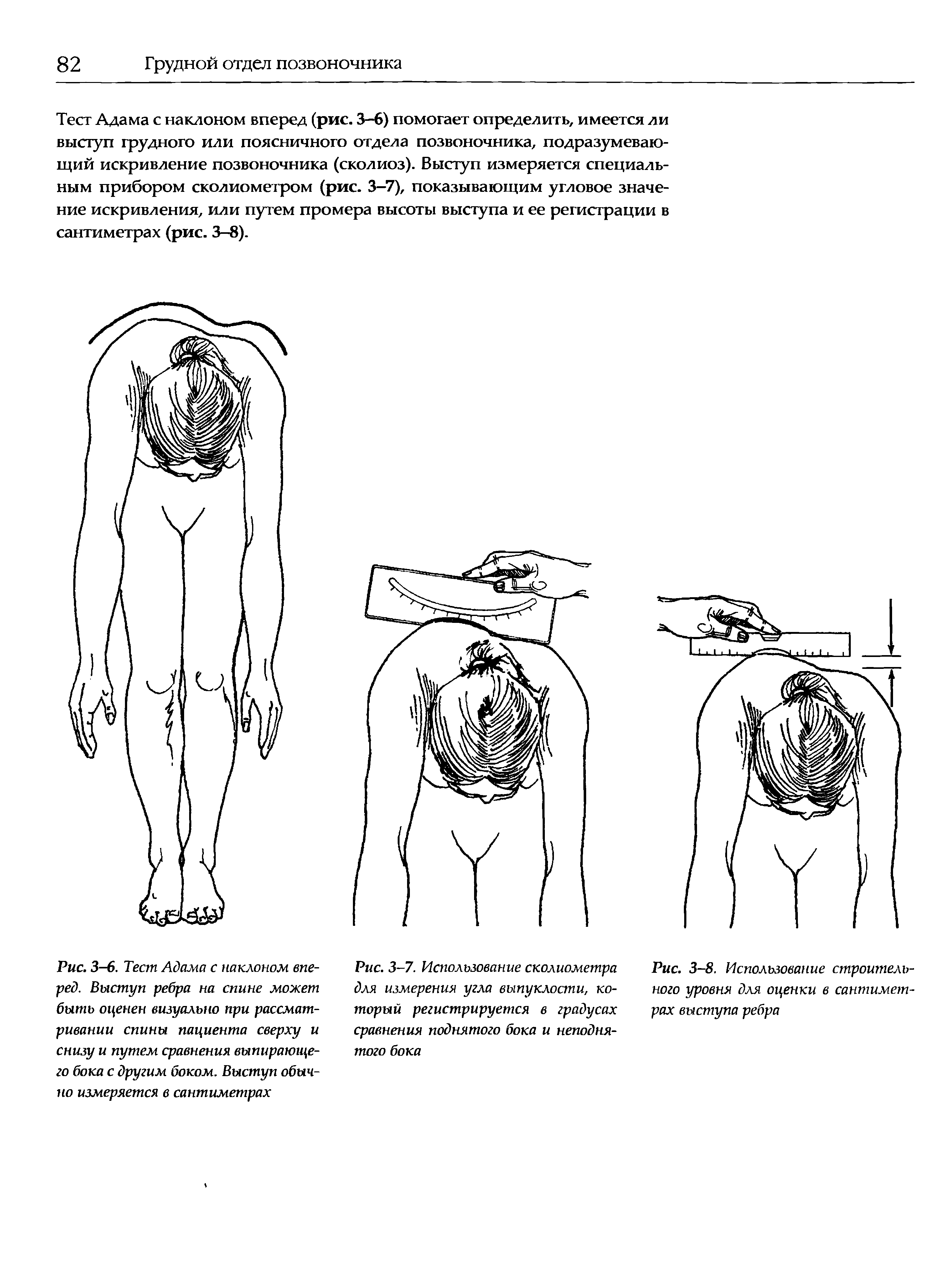 Рис. 3-6. Тест Адама с наклоном вперед. Выступ ребра на спине может быть оценен визуально при рассматривании спины пациента сверху и снизу и путем сравнения выпирающего бока с другим боком. Выступ обычно измеряется в сантиметрах...