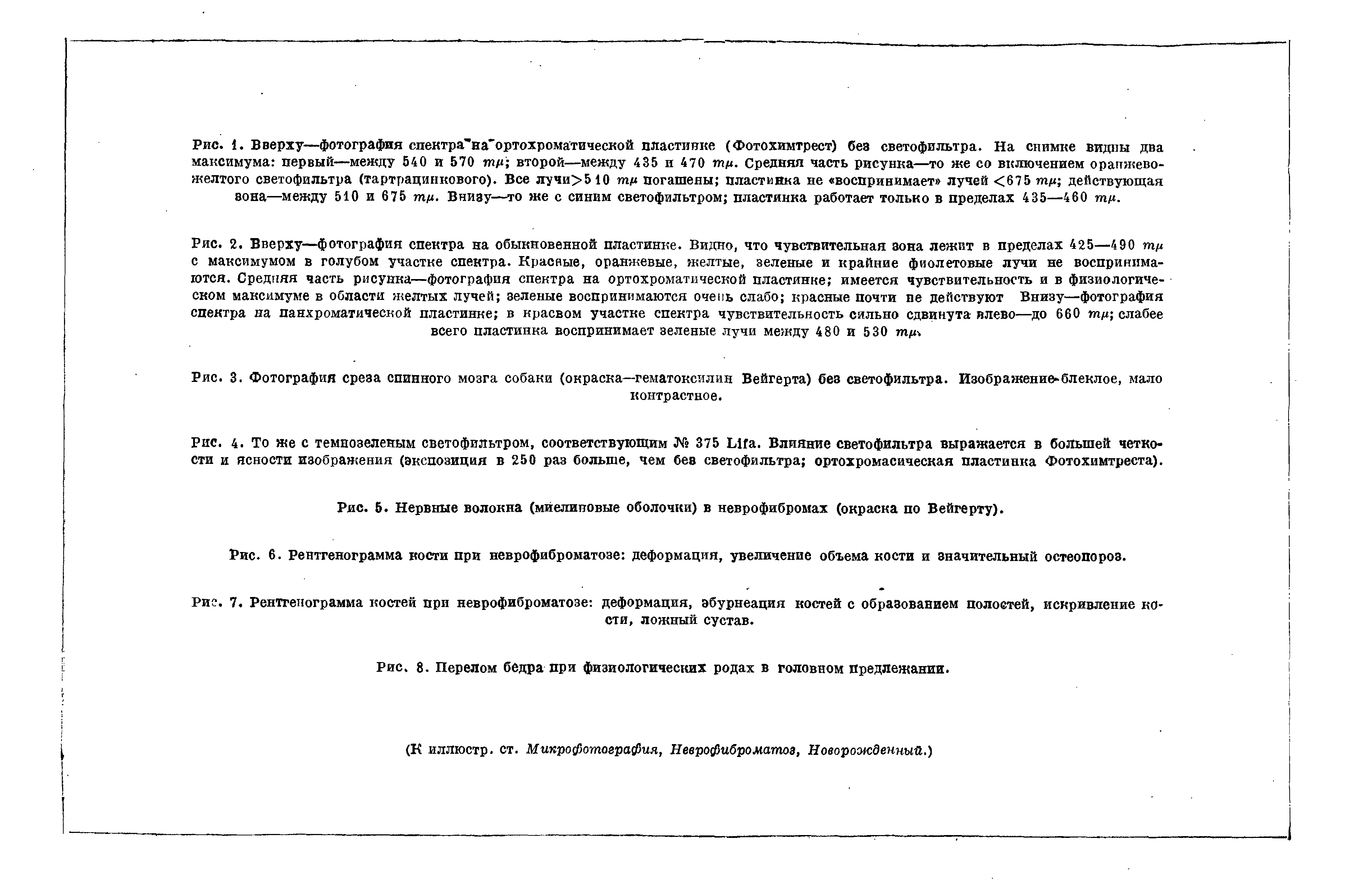 Рис. 5. Нервные волокна (миелиновые оболочки) в неврофибромах (окраска по Вейгерту).