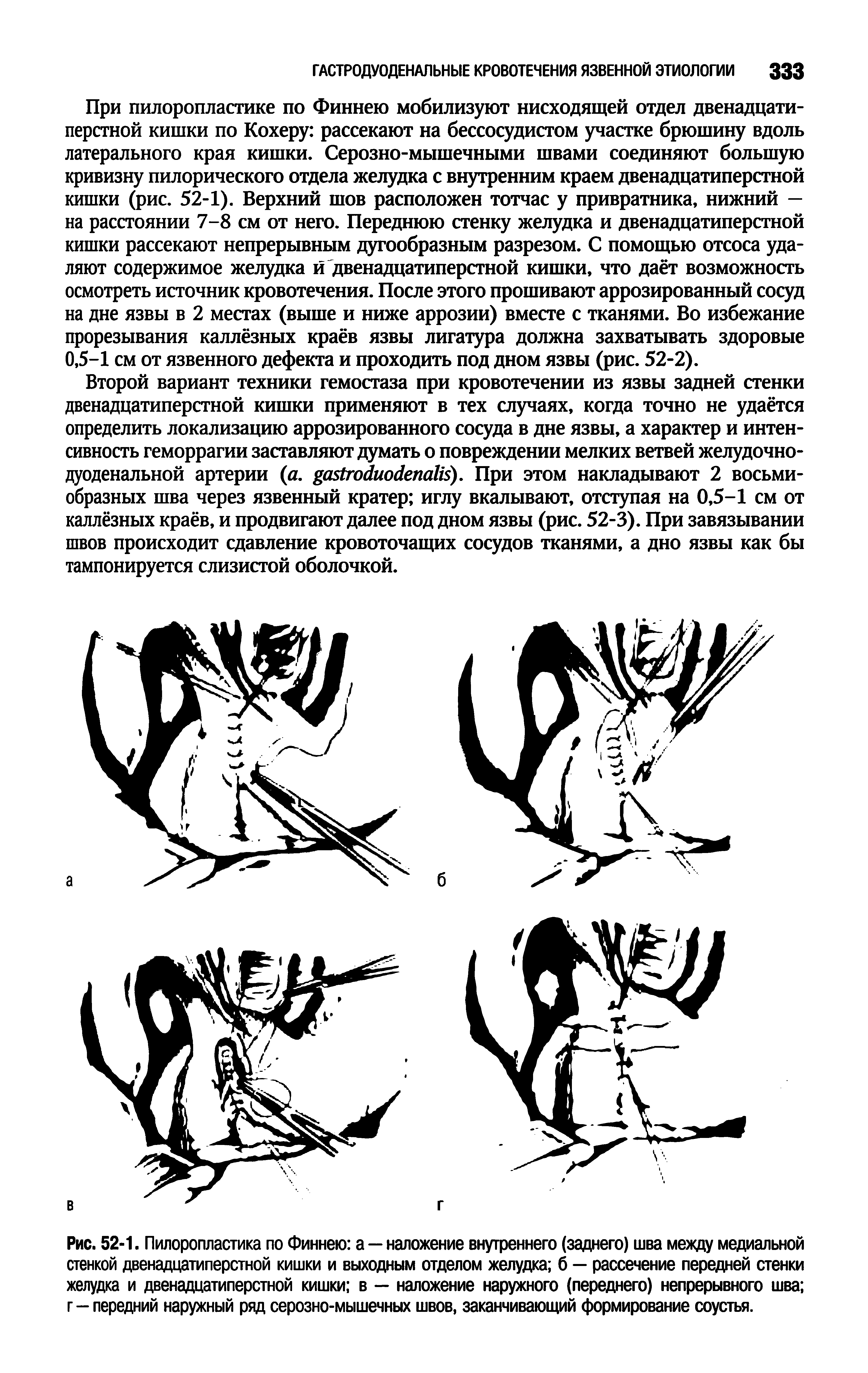 Рис. 52-1. Пилоропластика по Финнею а — наложение внутреннего (заднего) шва между медиальной стенкой двенадцатиперстной кишки и выходным отделом желудка б — рассечение передней стенки желудка и двенадцатиперстной кишки в — наложение наружного (переднего) непрерывного шва г - передний наружный ряд серозно-мышечных швов, заканчивающий формирование соустья.