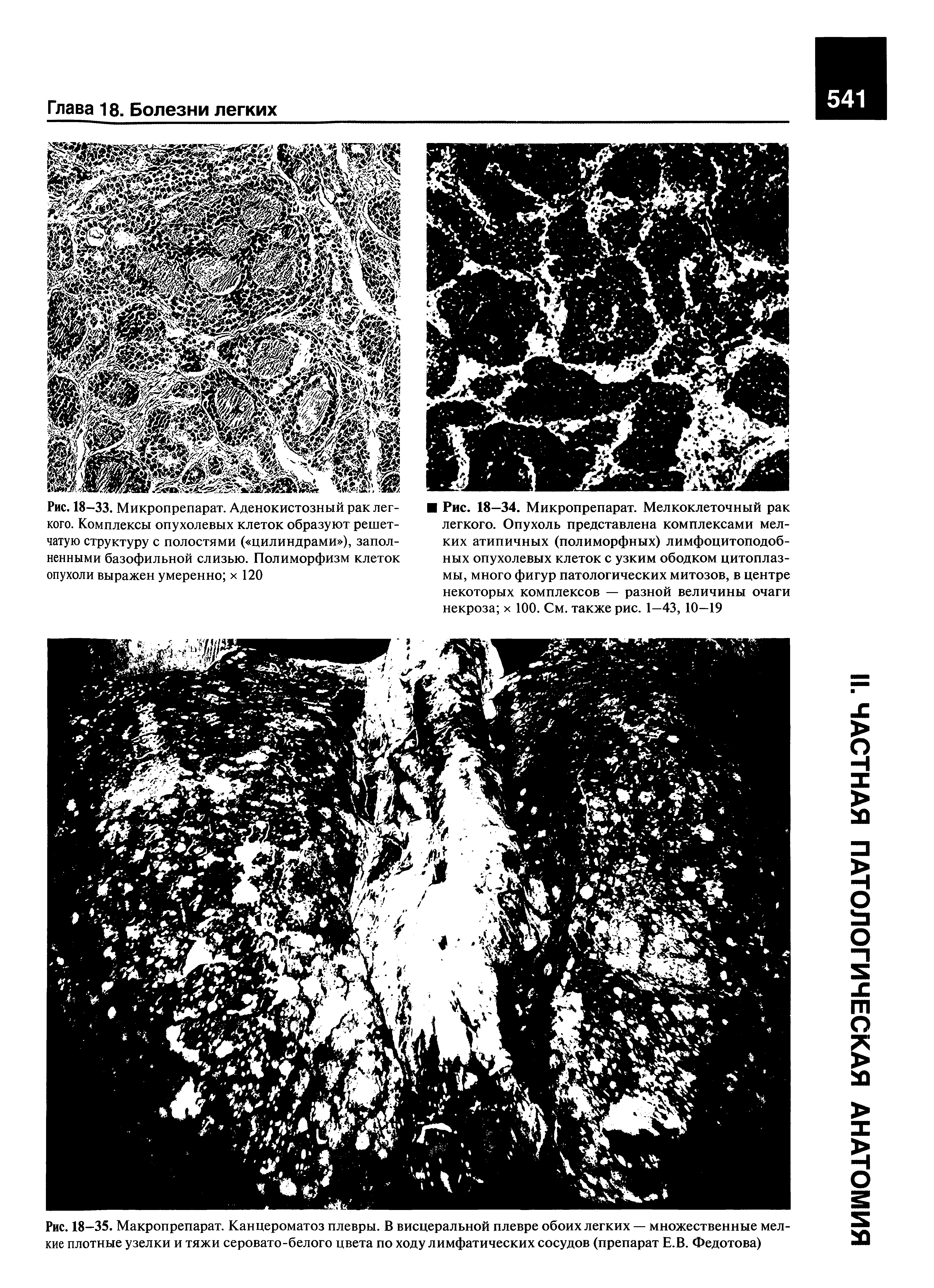 Рис. 18-35. Макропрепарат. Канцероматоз плевры. В висцеральной плевре обоих легких — множественные мелкие плотные узелки и тяжи серовато-белого цвета по ходу лимфатических сосудов (препарат Е.В. Федотова)...