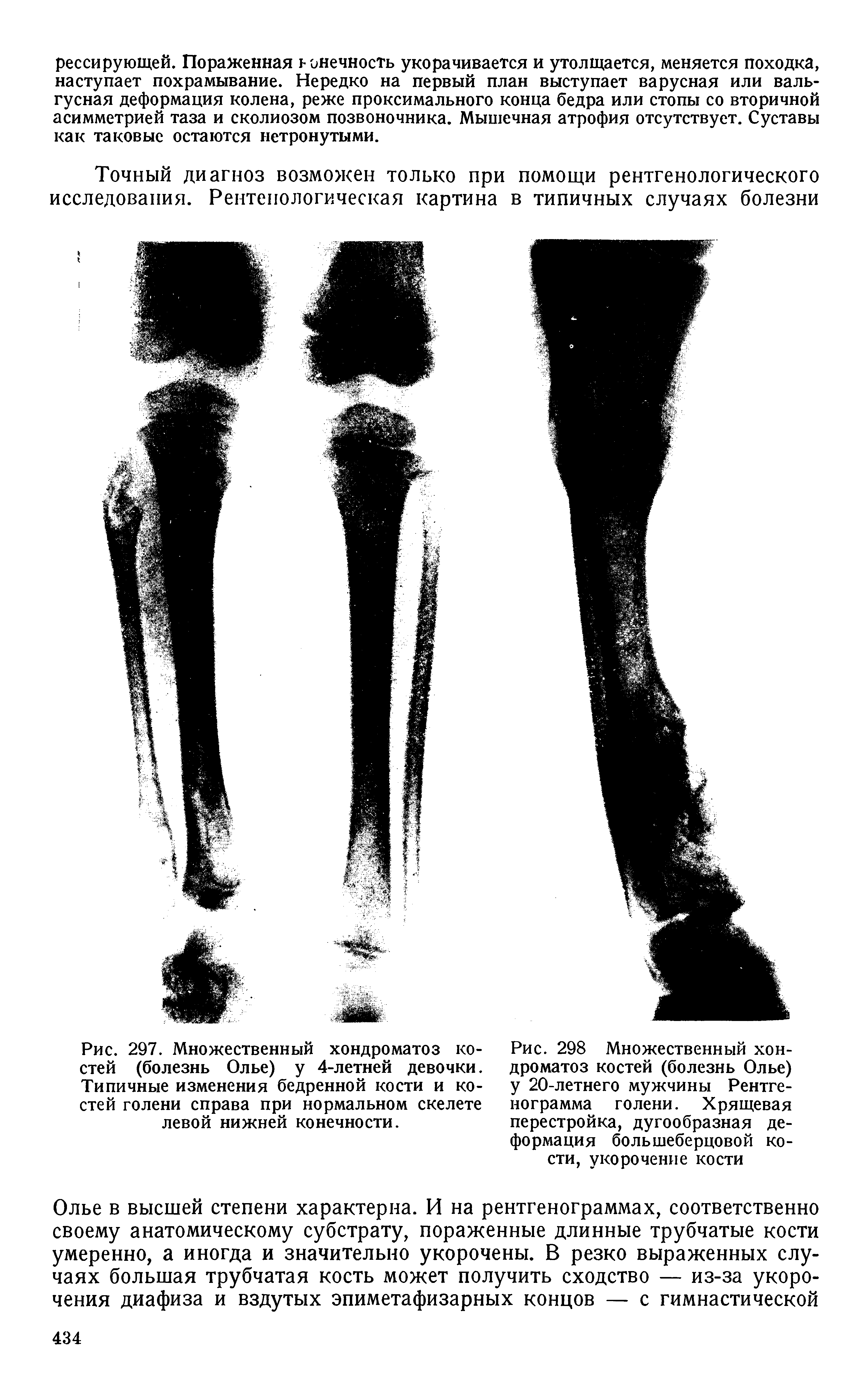 Рис. 298 Множественный хондроматоз костей (болезнь Олье) у 20-летнего мужчины Рентгенограмма голени. Хрящевая перестройка, дугообразная деформация большеберцовой кости, укорочение кости...