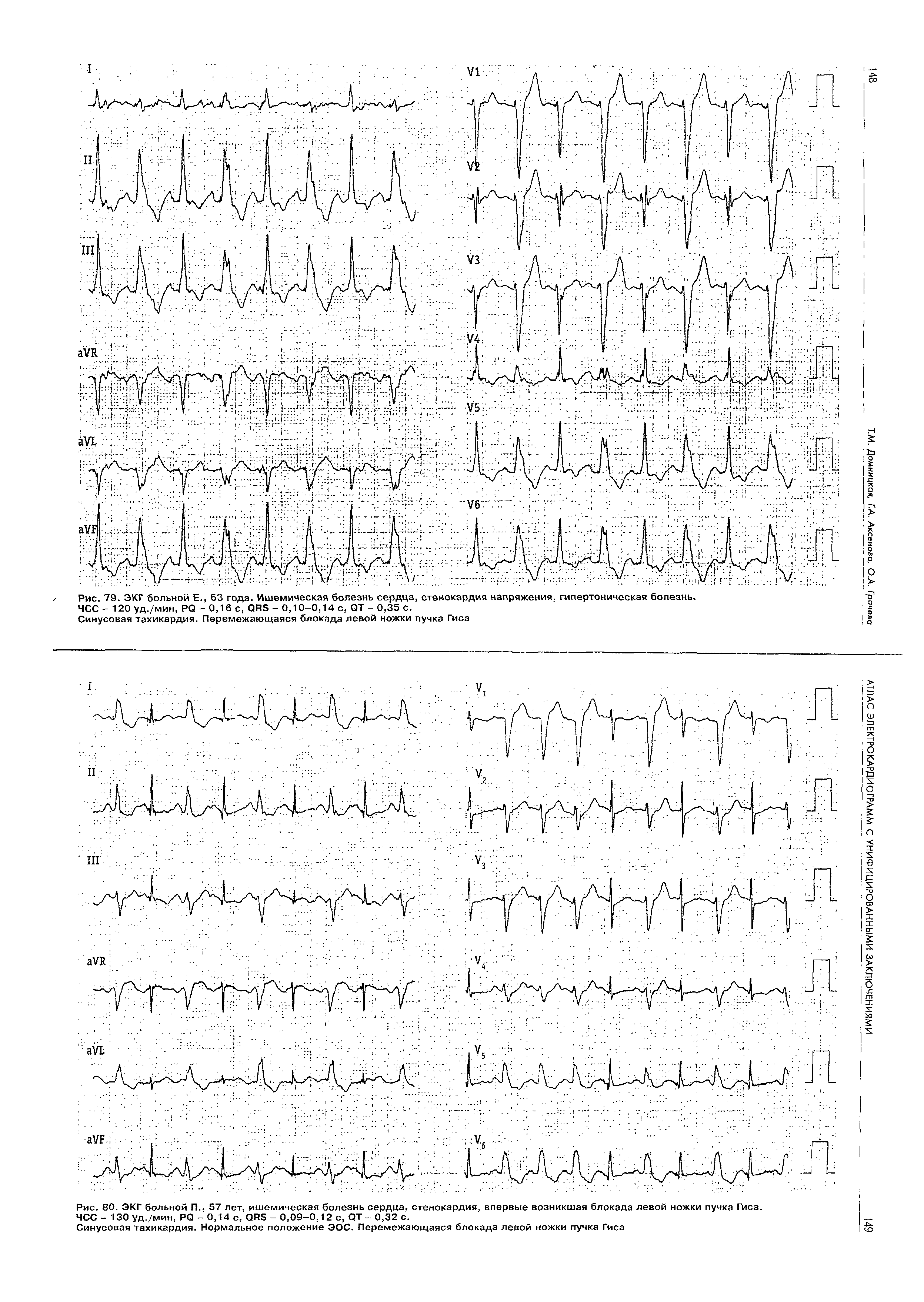 Рис. 80. ЭКГ больной П., 57 лет, ишемическая болезнь сердца, стенокардия, впервые возникшая блокада левой ножки пучка Гиса. ЧСС - 130 уд./мин, РО - 0,14 с, ОАБ - 0,09-0,12 с, ОТ - 0,32 с.