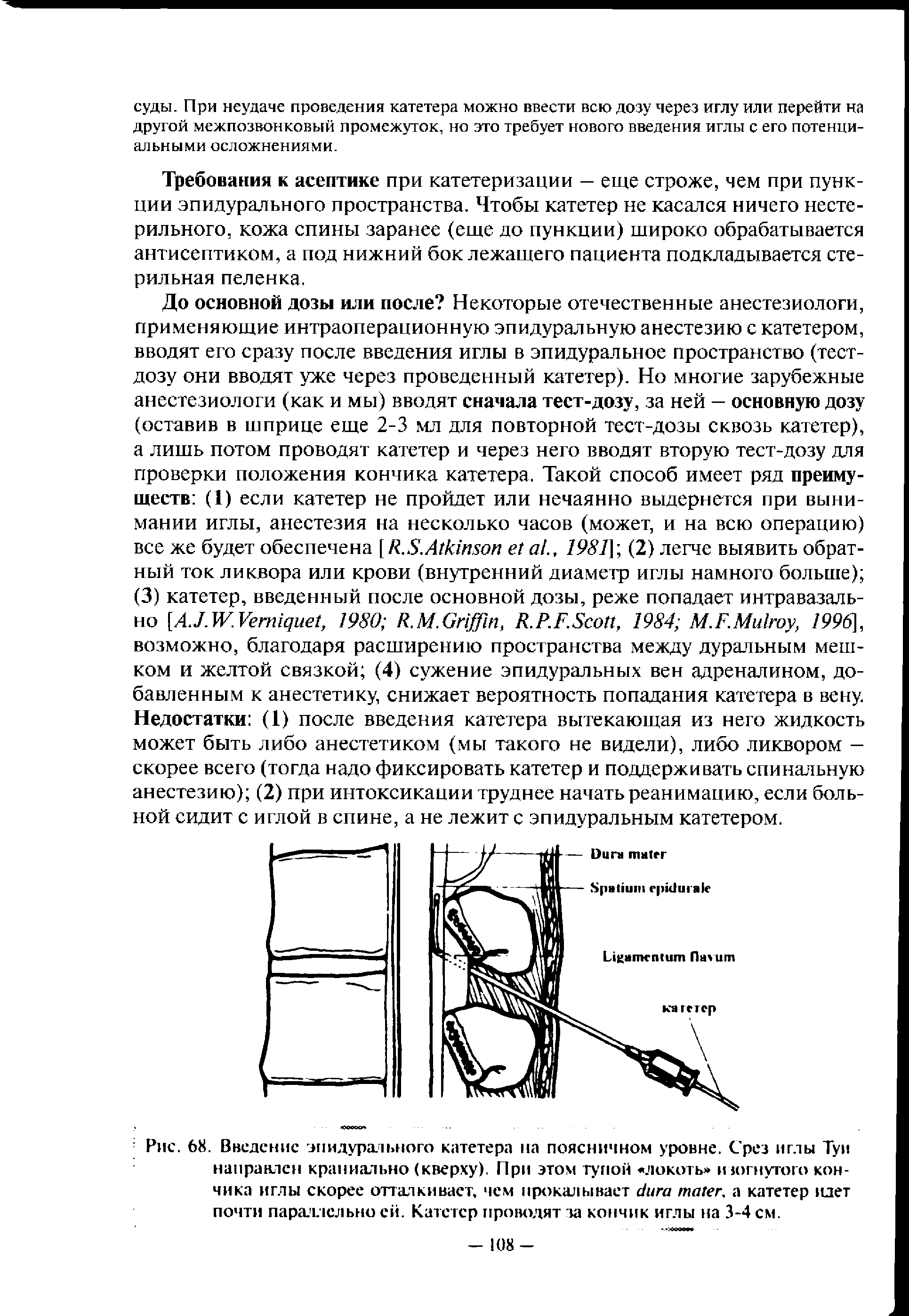 Рис. 68. Введение эпидурального катетера на поясничном уровне. Срез иглы Туи направлен краниально (кверху). При этом тупой локоть изогнутого кончика иглы скорее отталкивает, чем прокалывает , а катетер идет почти параллельно ей. Катетер проводят за кончик иглы на 3-4 см.