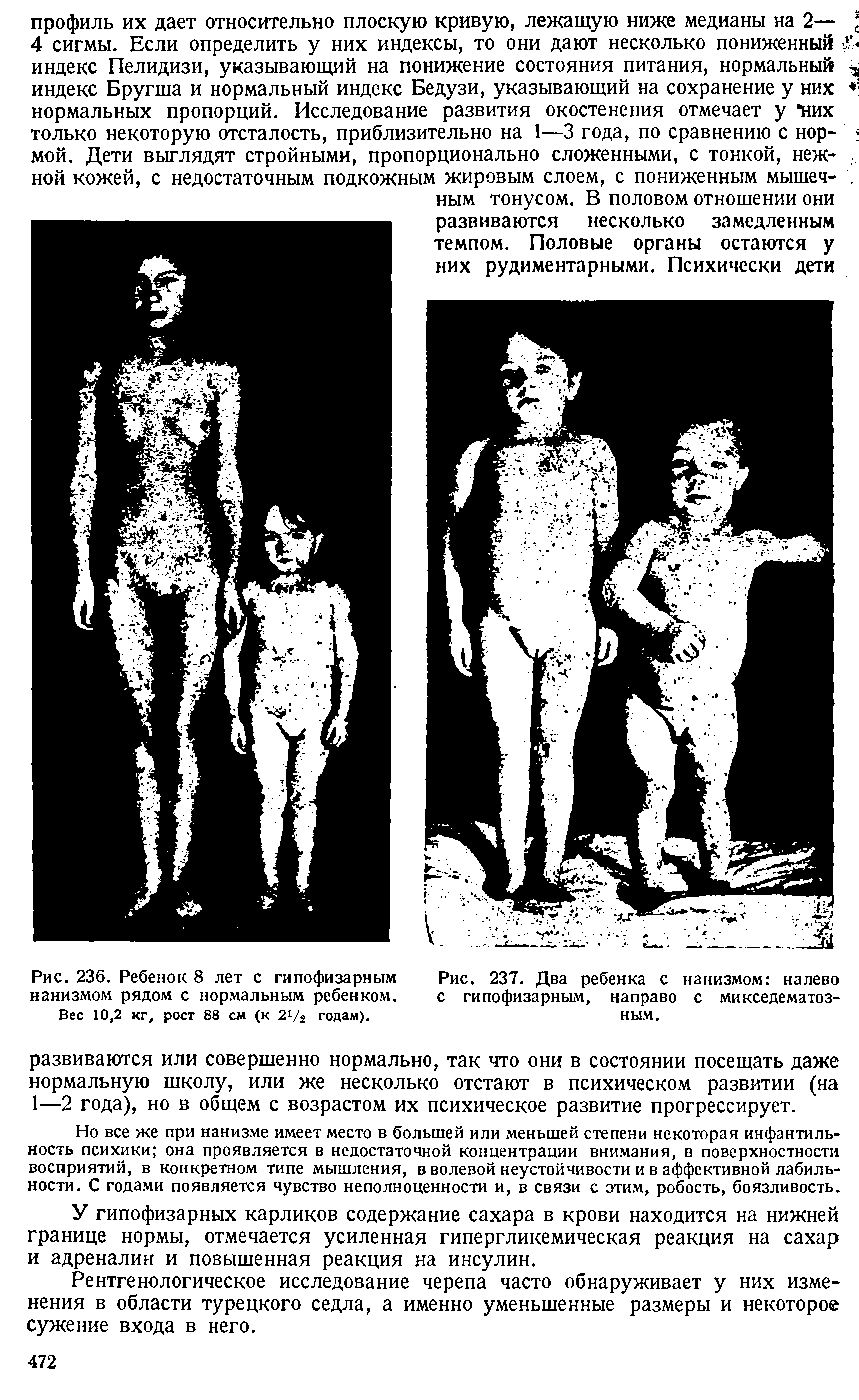 Рис. 237. Два ребенка с нанизмом налево с гипофизарным, направо с микседематозным.