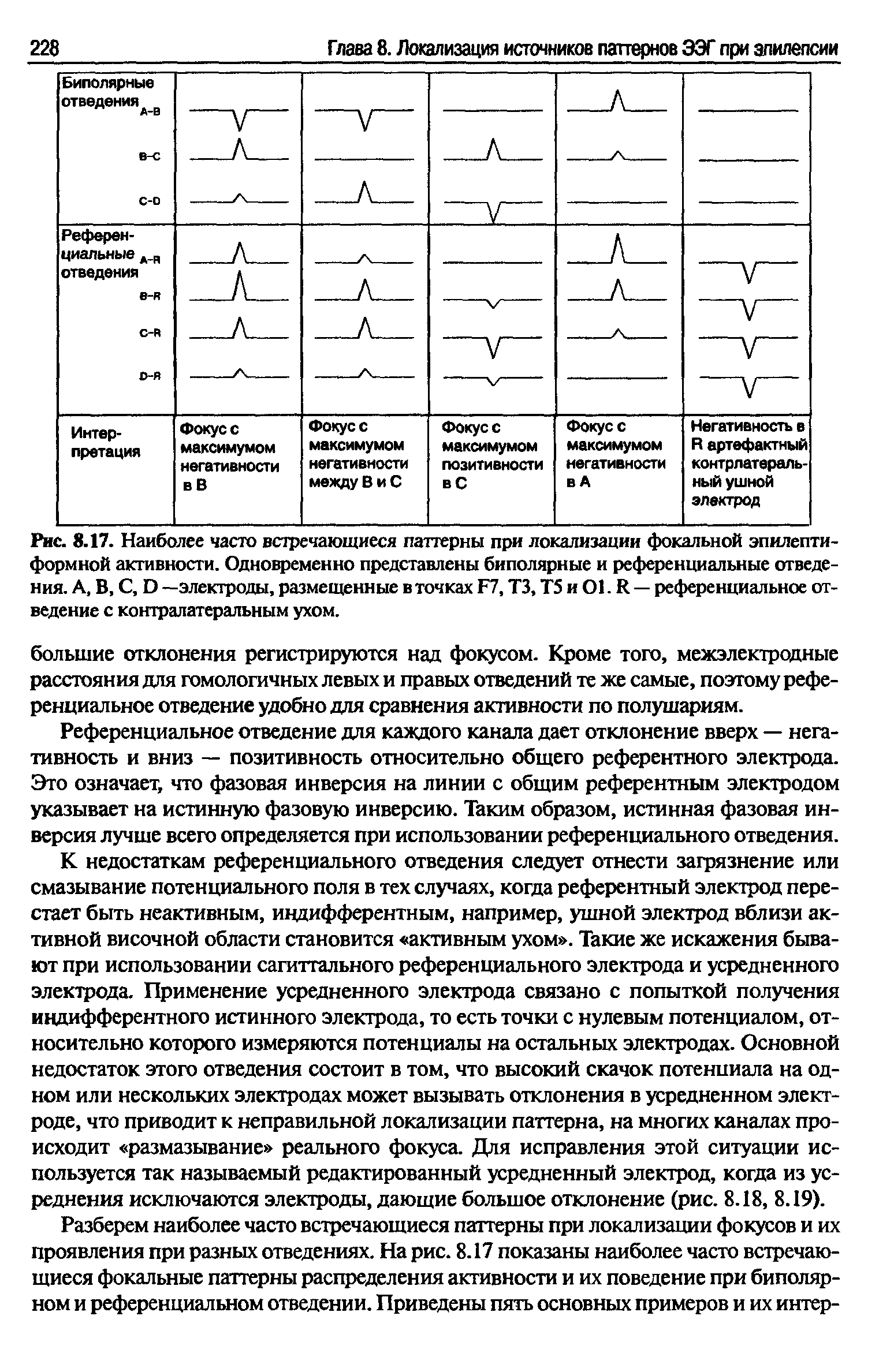 Рис. 8.17. Наиболее часто встречающиеся паттерны при локализации фокальной эпилептиформной активности. Одновременно представлены биполярные и референциальные отведения. А, В, С, Э —электроды, размещенные в точках Р7, ТЗ, Т5 и О1. И — референциальное отведение с контралатеральным ухом.