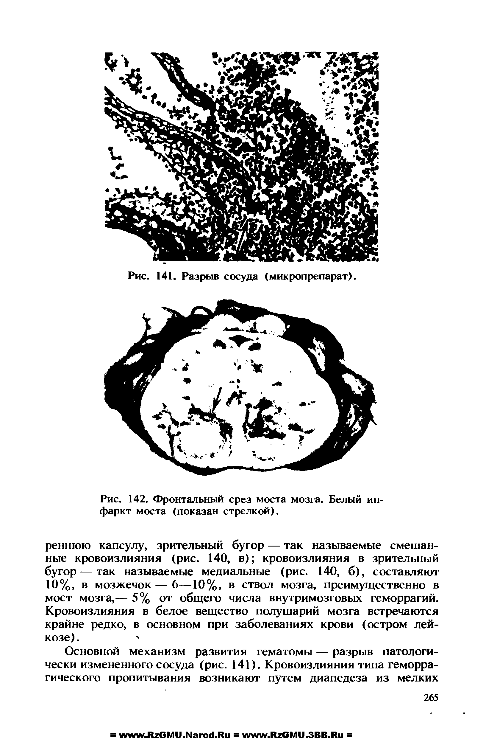 Рис. 142. Фронтальный срез моста мозга. Белый инфаркт моста (показан стрелкой).