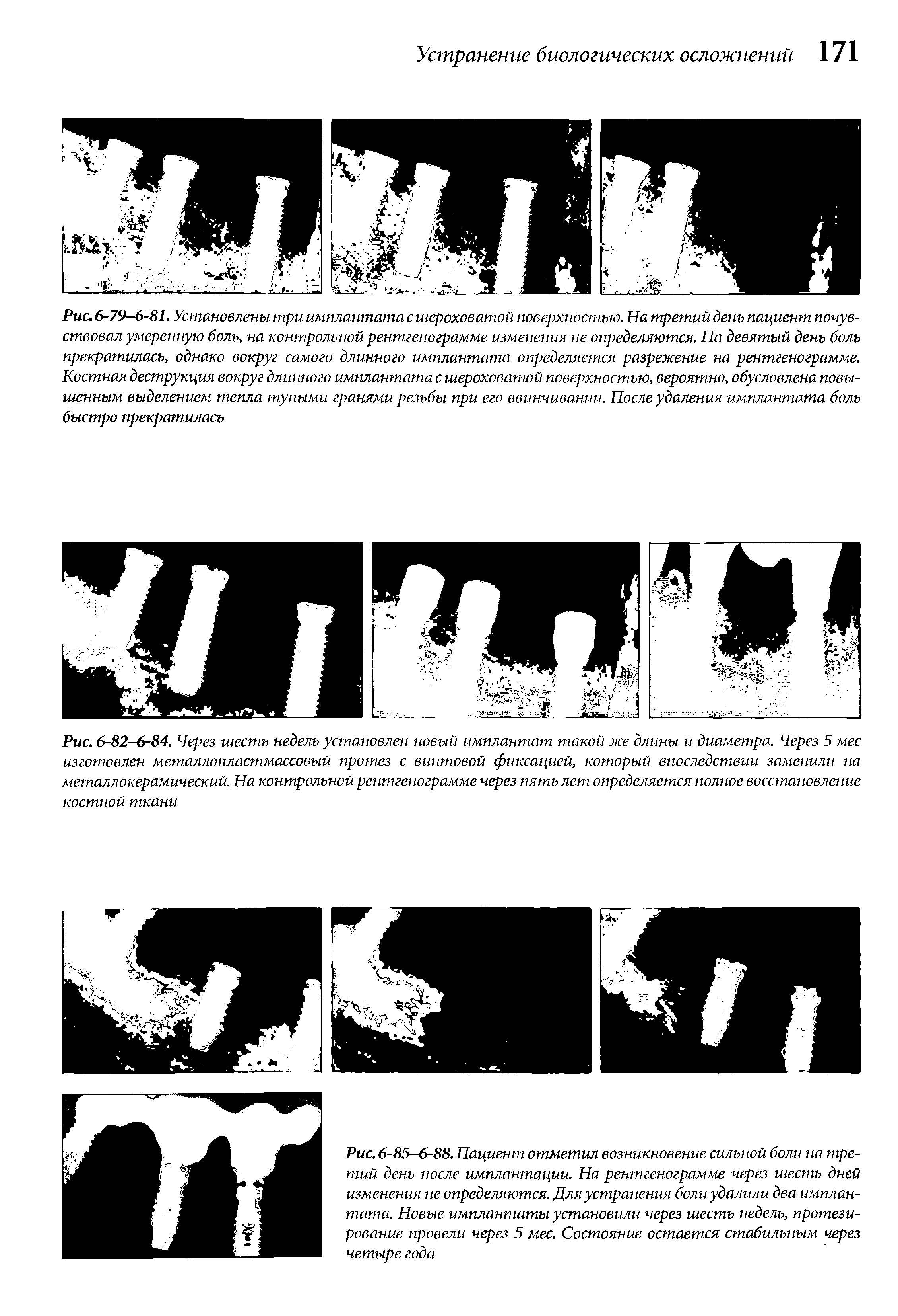 Рис. 6-82-6-84. Через шесть недель установлен новый имплантат такой же длины и диаметра. Через 5 мес изготовлен металле пластмассовый протез с винтовой фиксацией, который впоследствии заменили на металлокерамический. На контрольной рентгенограмме через пять лет определяется полное восстановление костной ткани...