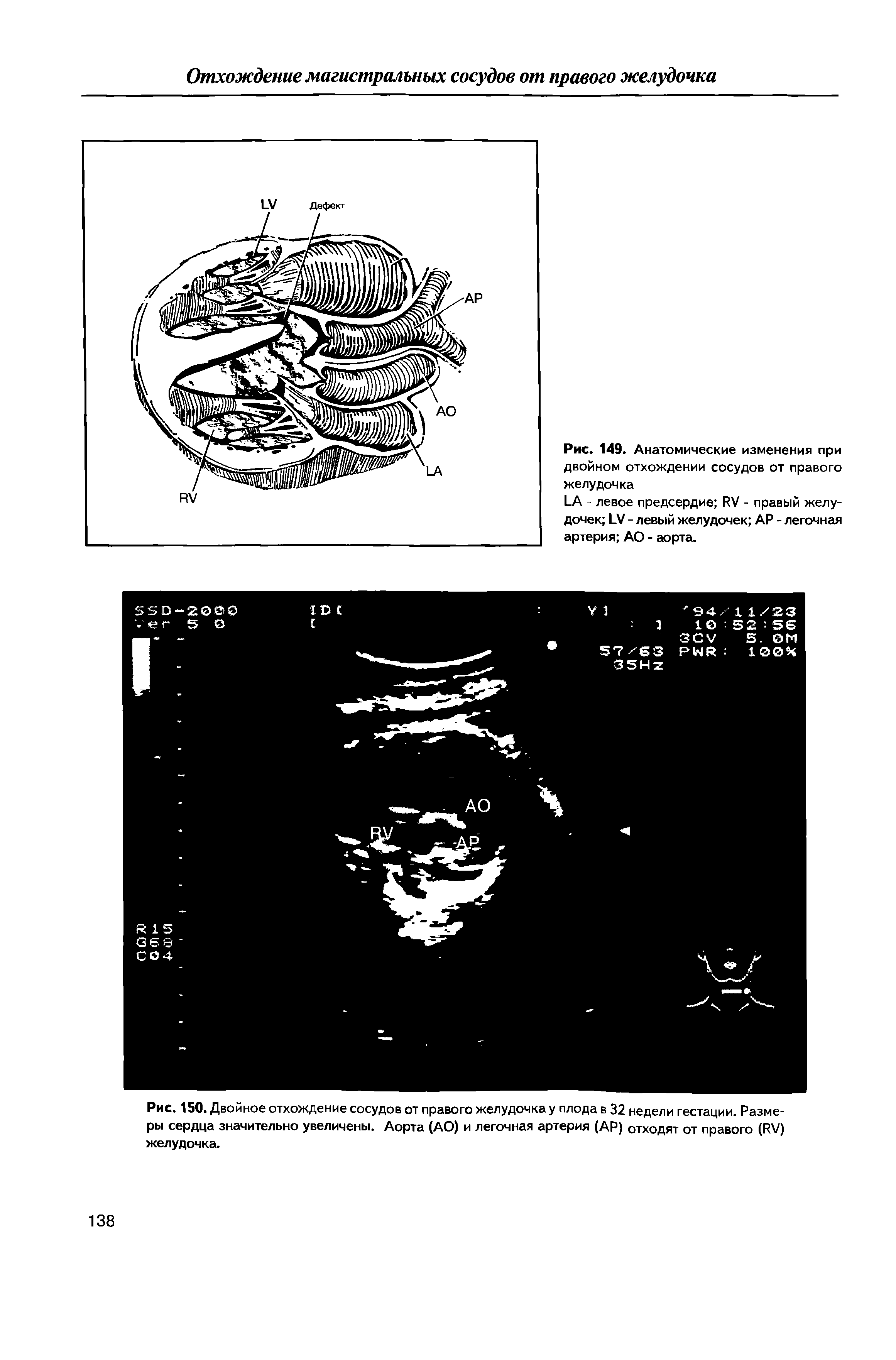 Рис. 150. Двойное отхождение сосудов от правого желудочка у плода в 32 недели гестации. Размеры сердца значительно увеличены. Аорта (АО) и легочная артерия (АР) отходят от правого ( /) желудочка.