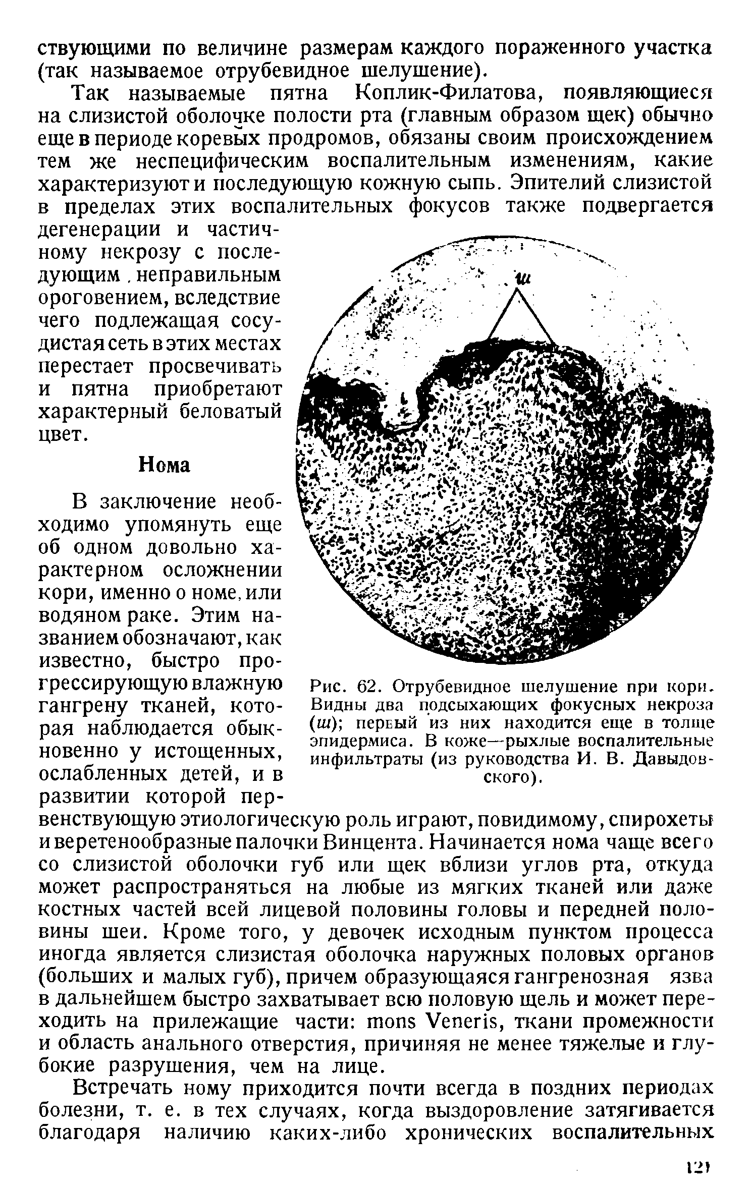 Рис. 62. Отрубевидное шелушение при кори. Видны два подсыхающих фокусных некроза (ш) первый из них находится еще в толще эпидермиса. В коже—рыхлые воспалительные инфильтраты (из руководства И. В. Давыдовского).